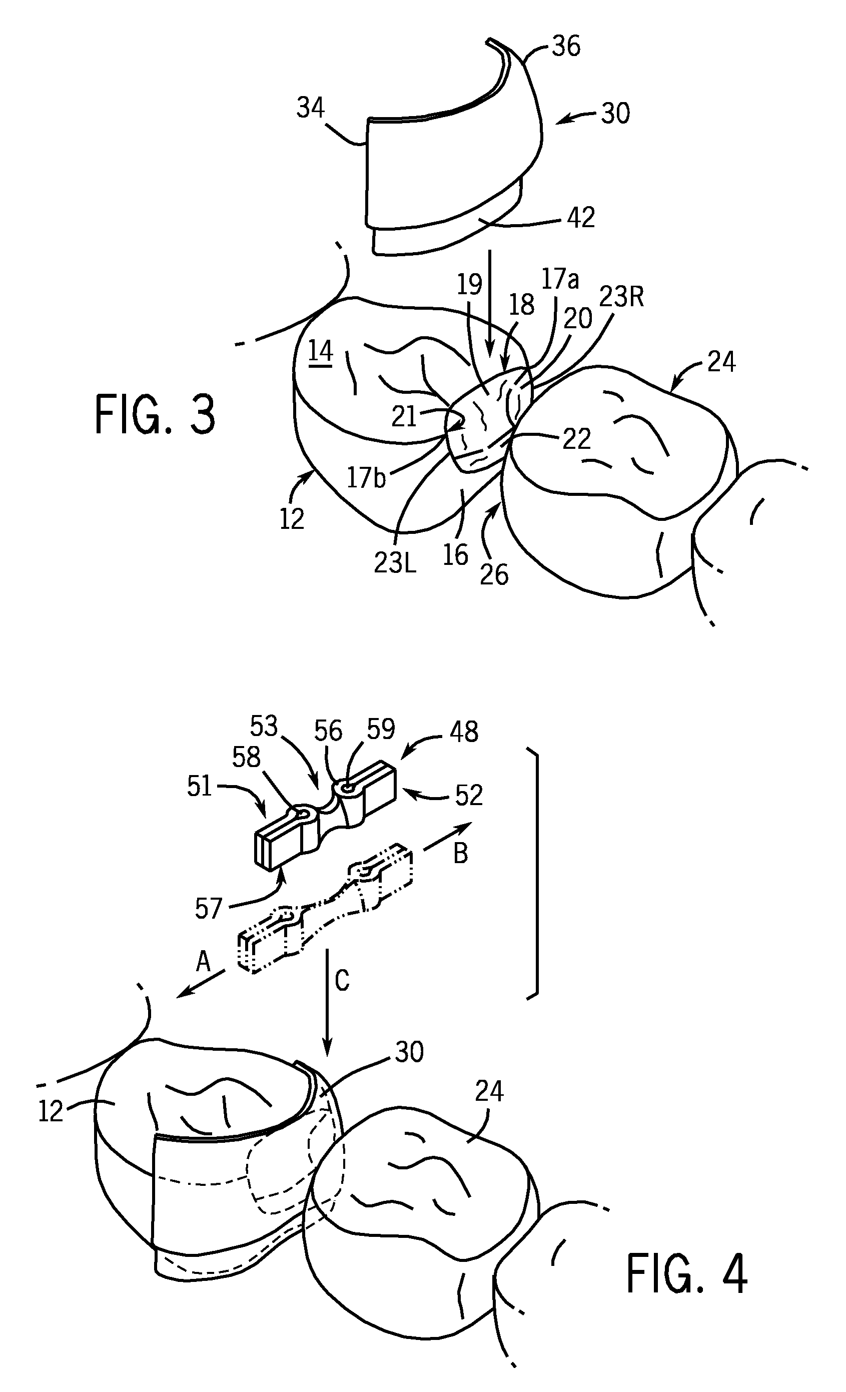 Matrix Stabilizer Devices And A Seamless, Single Load Cavity Preparation And Filling Technique