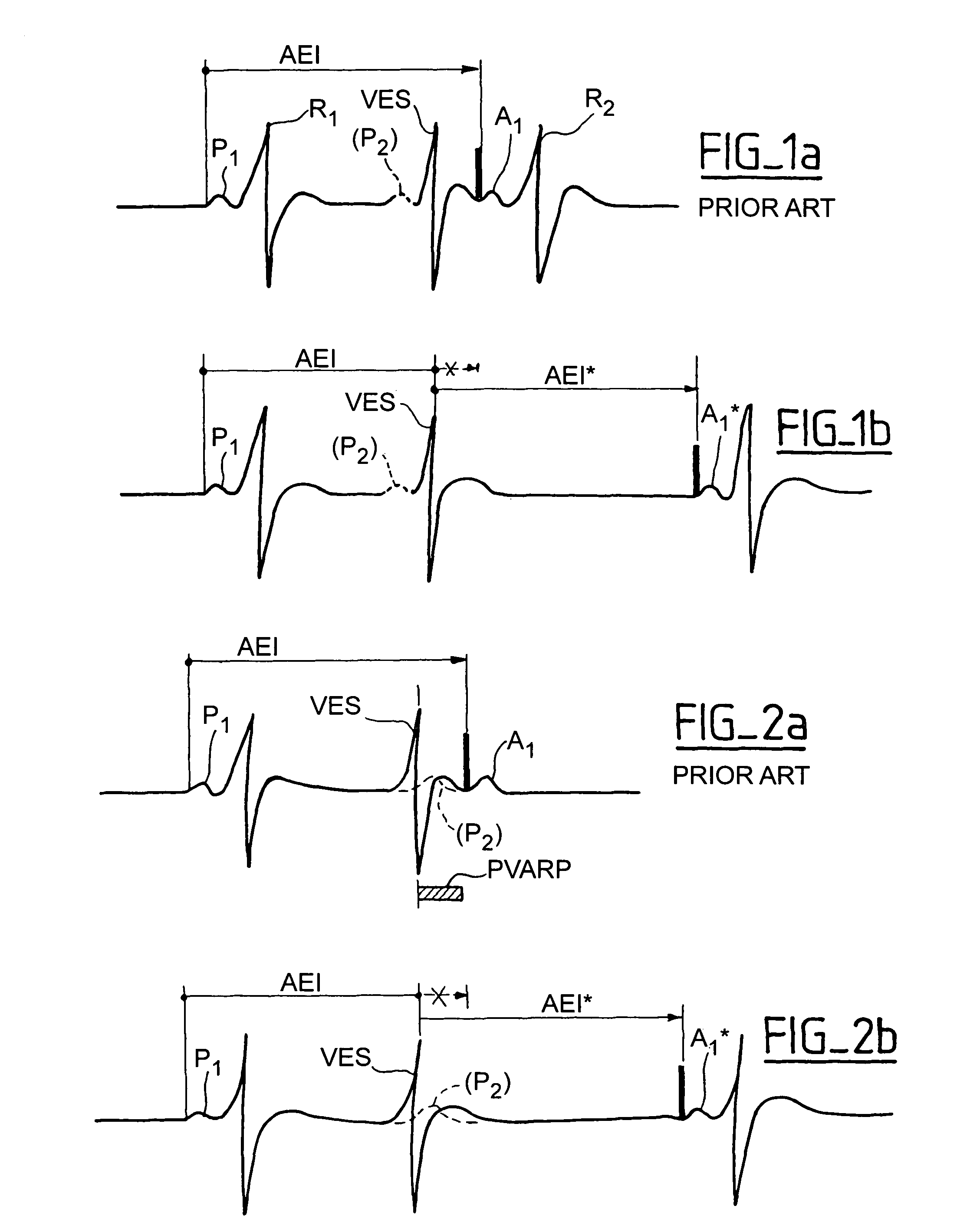 Active implantable device medical such as pacemaker, defibrillator and/or cardiovertor of the AAI or AAI/DDD type