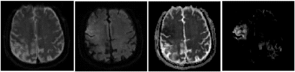 Acute cerebral ischemia image segmentation model acquisition method and acute cerebral ischemia image segmentation method