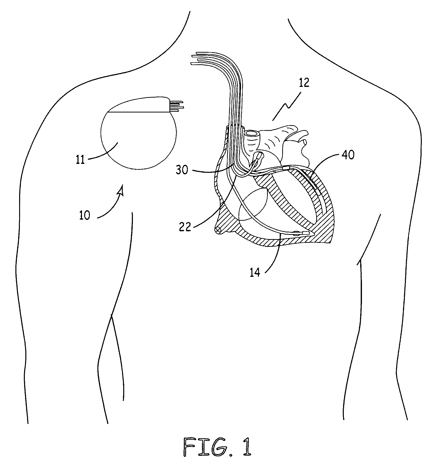 Trans-septal/trans-myocardial ventricular pacing lead