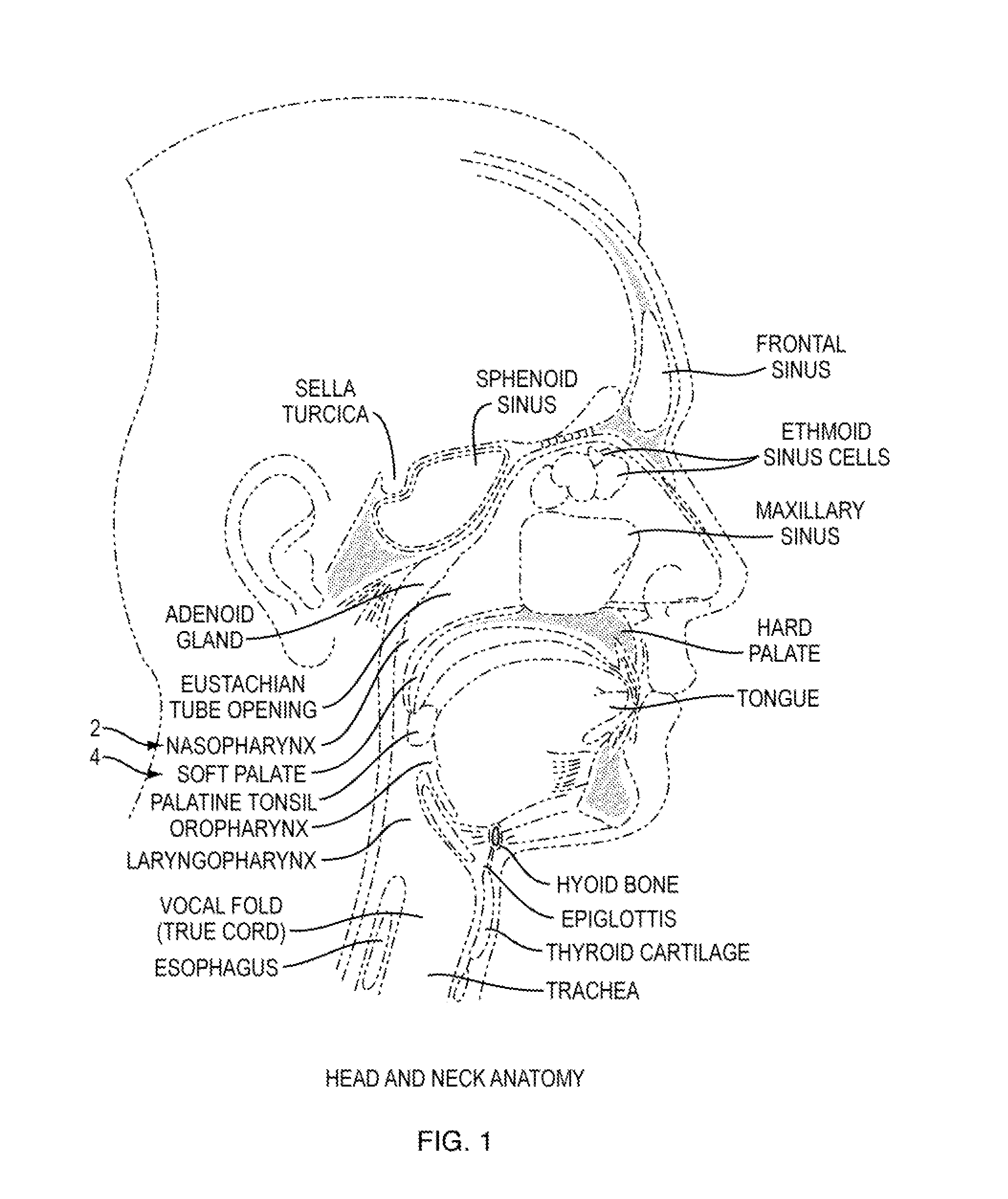 Nasopharyngeal Device for Obstructive Sleep Apnea Syndrome