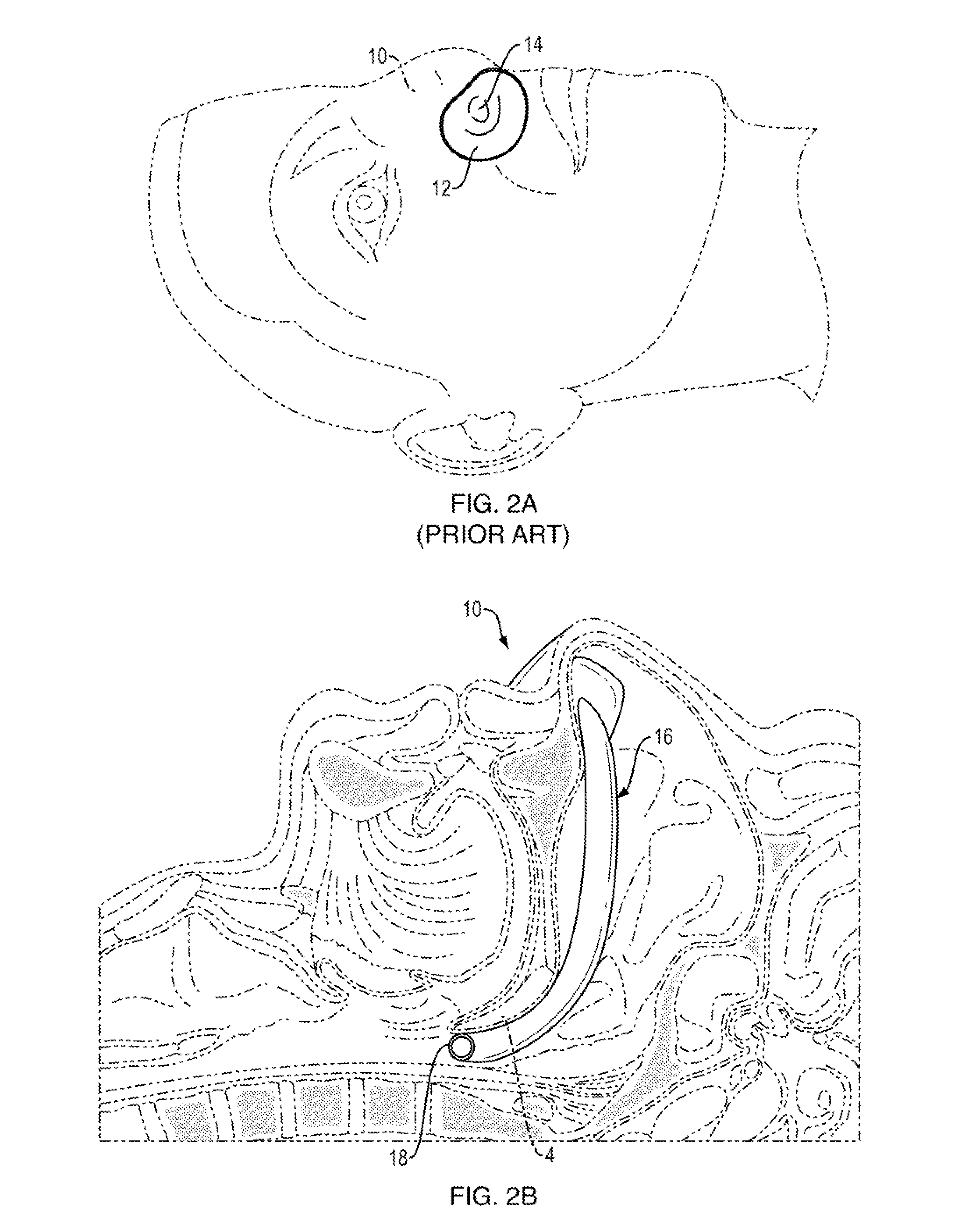 Nasopharyngeal Device for Obstructive Sleep Apnea Syndrome