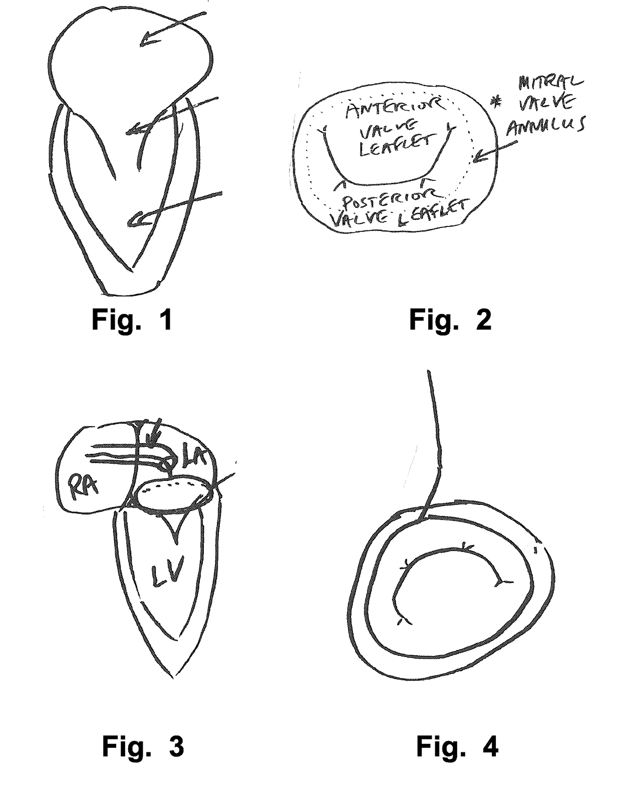 Device and method for reducing cardiac valve regurgitation