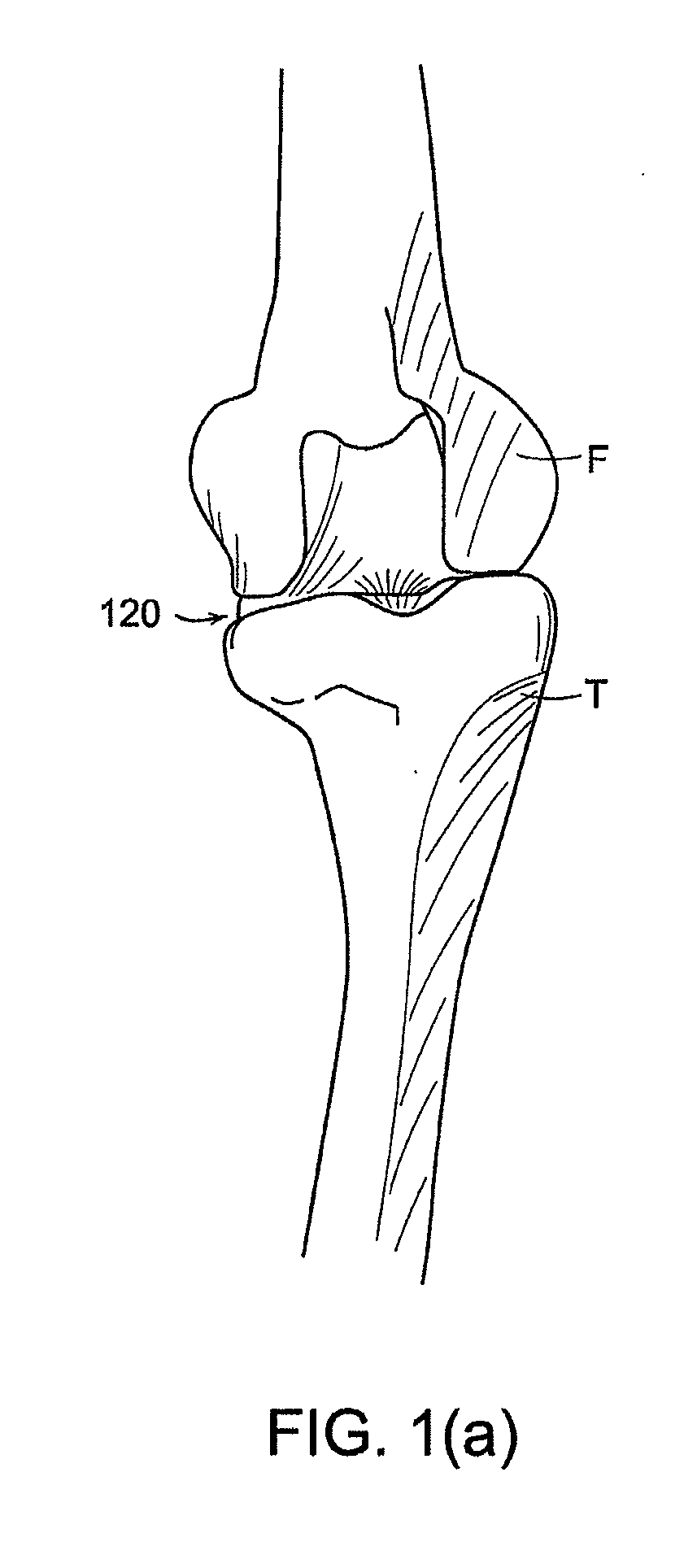 Implant Planning Using Captured Joint Motion Information