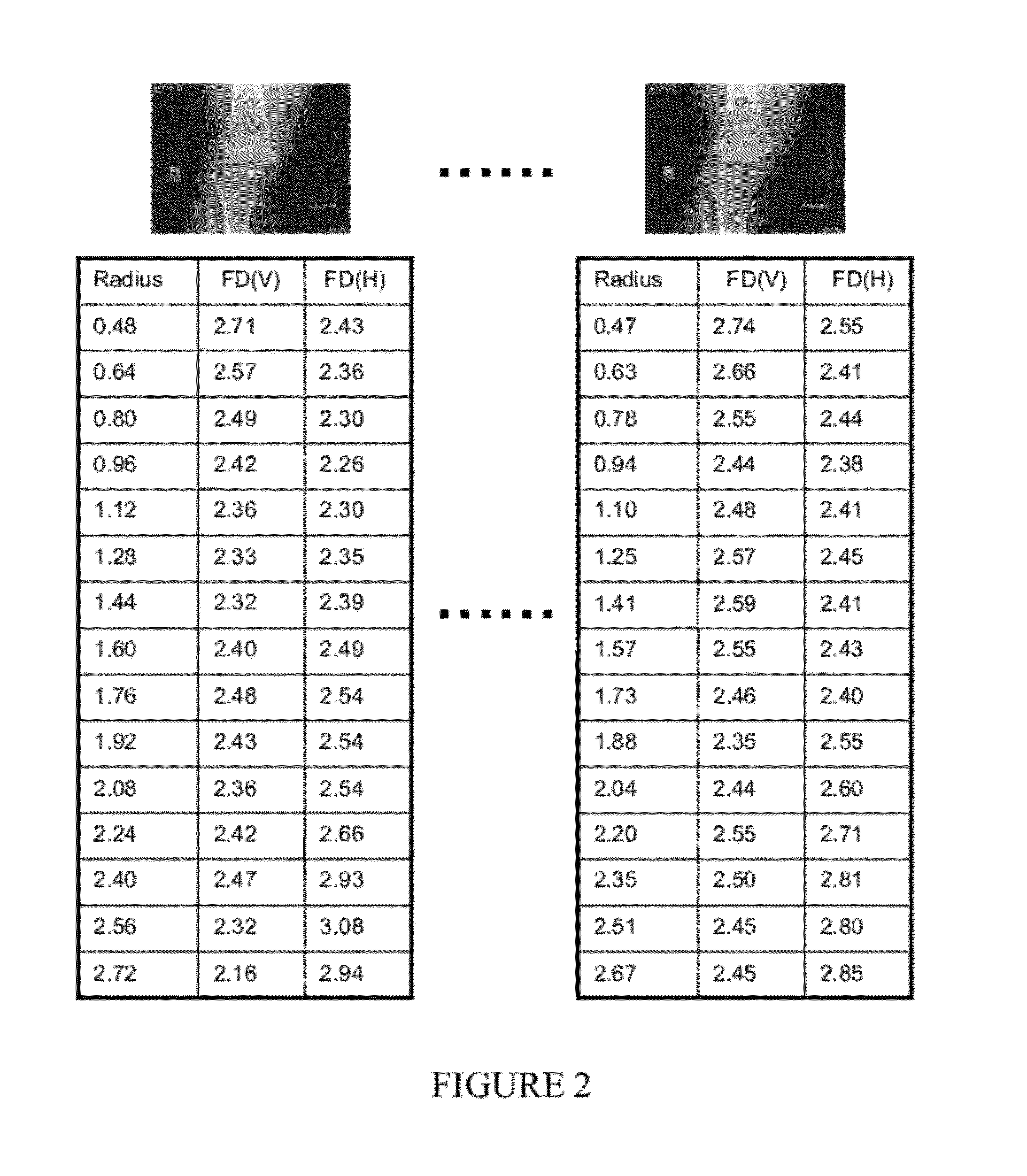 Systems and Methods for Generating an Osteoarthritis Progression Predictor and Systems and Methods for Using the Predictor