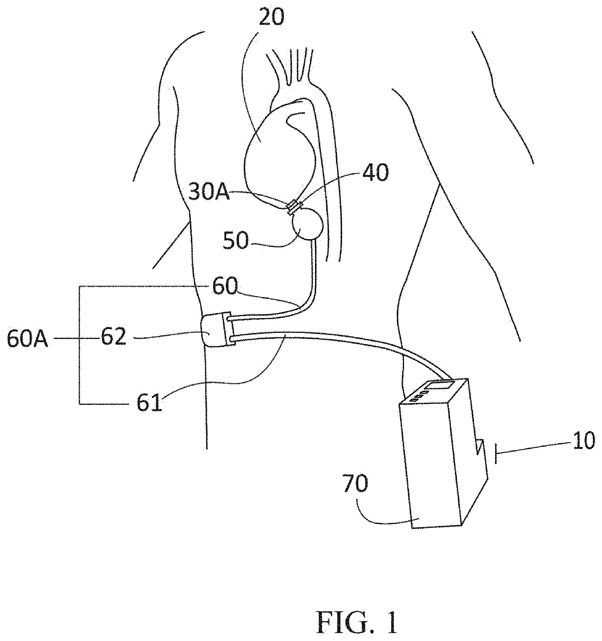 Implantable co-pulsatile epi-ventricular circulatory support system with sutureless flow cannula assembly