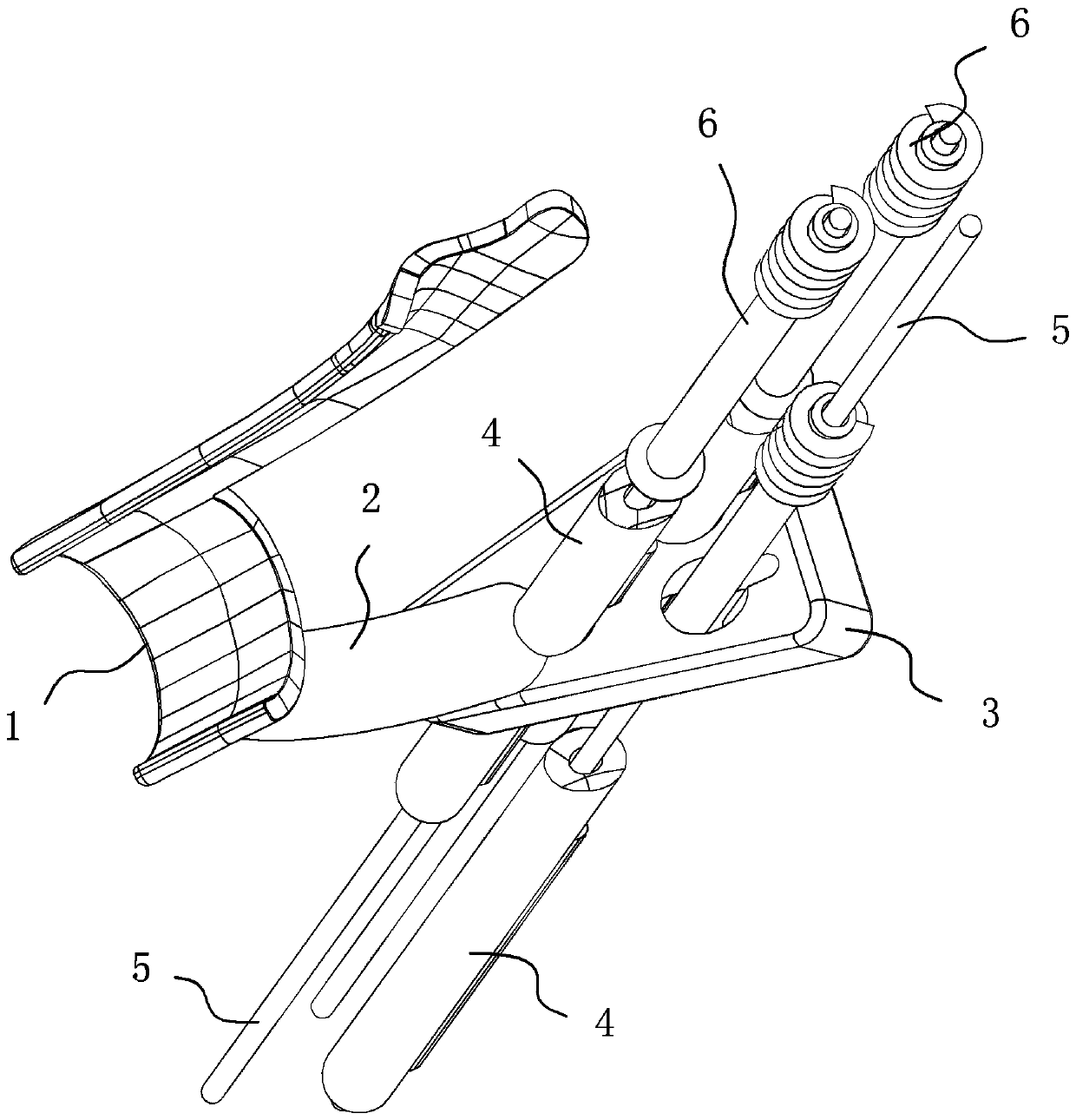 A three-dimensional reverse customized surgical navigator for femoral neck fracture