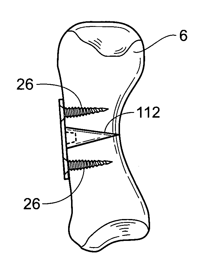 Devices, systems and methods for re-alignment of bone