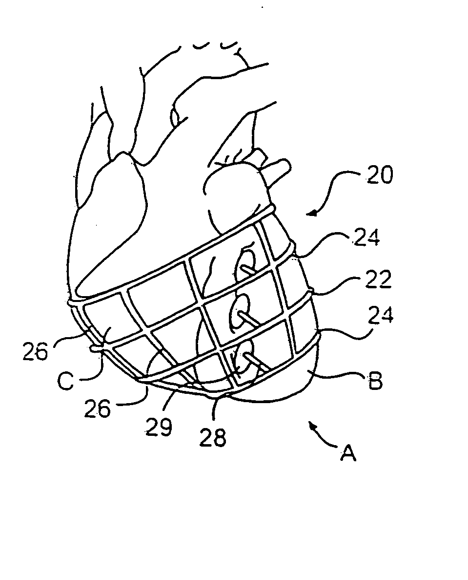 External stress reduction device and method