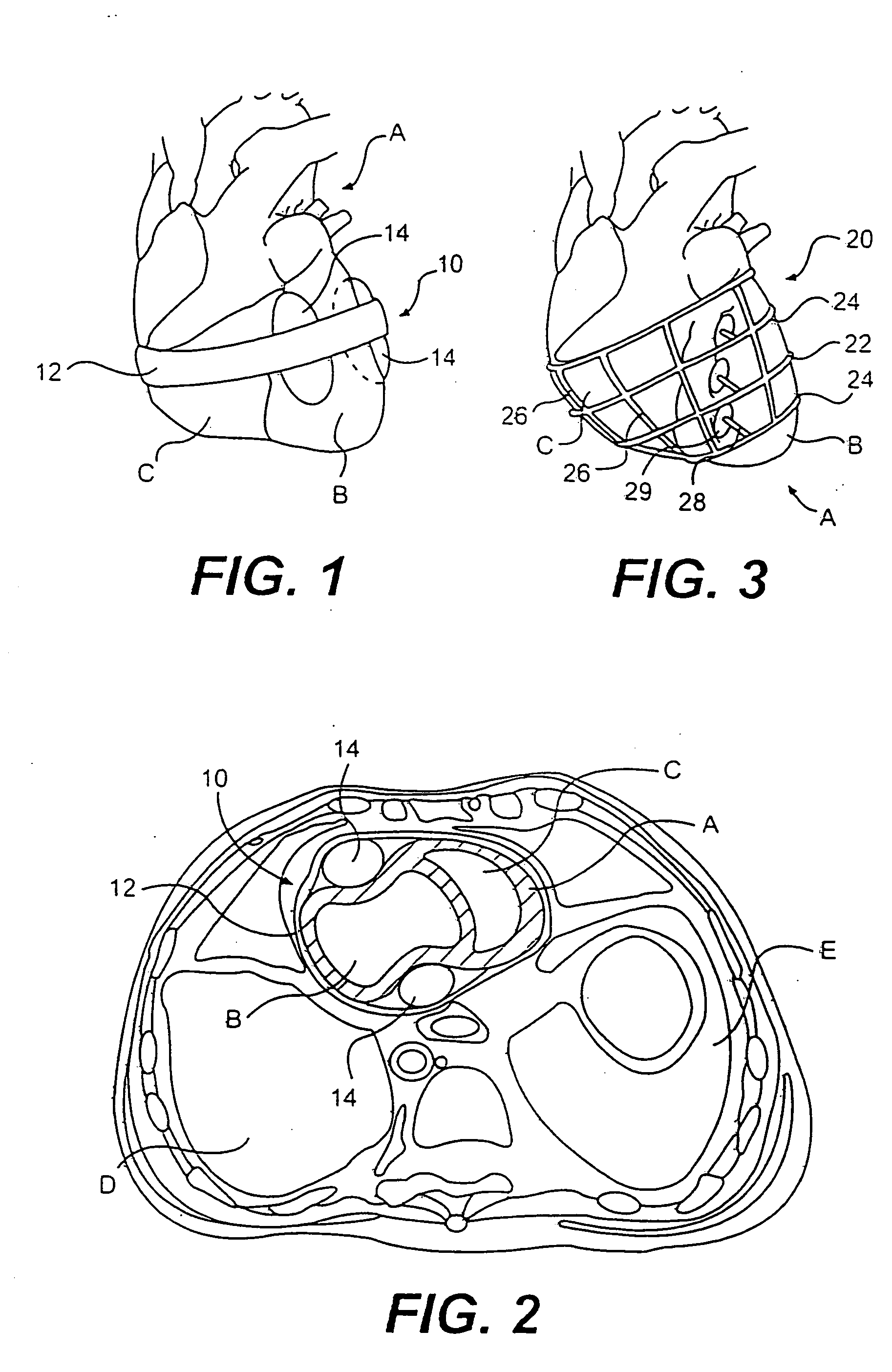 External stress reduction device and method