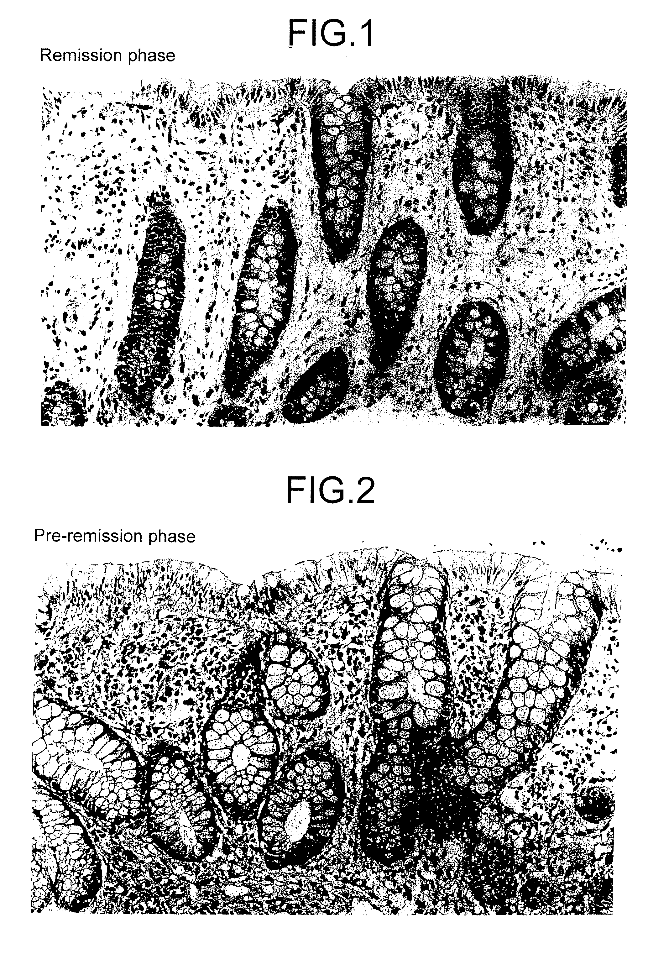 Method for clinical staging of ulcerative colitis or interstitial pneumonia and reagent kit for the same