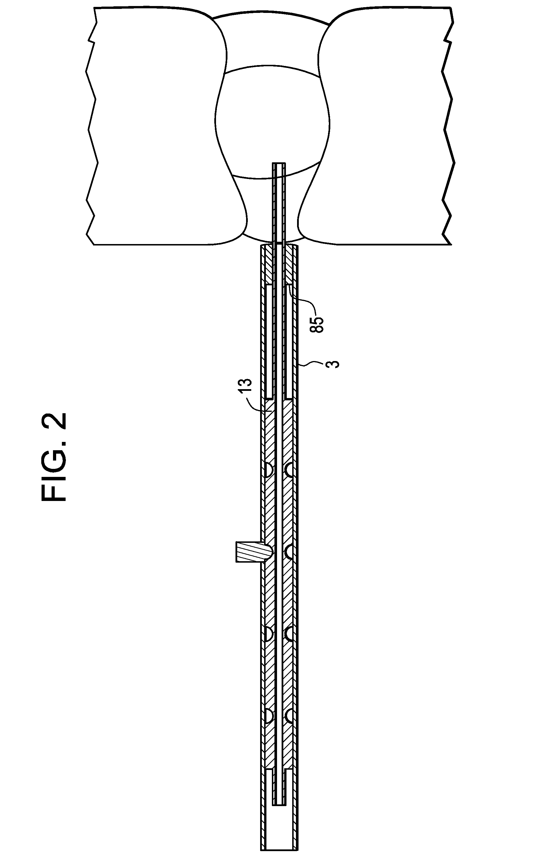 Intervertebral Disc Puncture and Treatment System