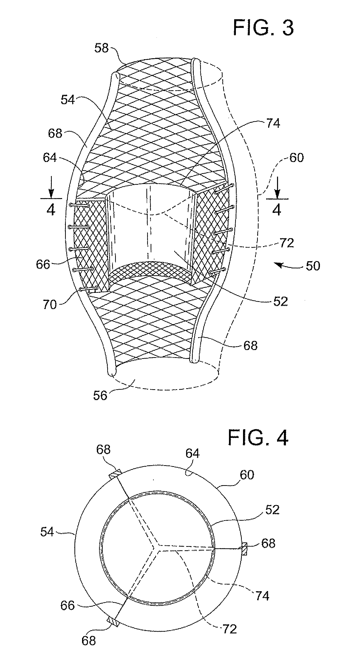 Implantable prosthetic valve with non-laminar flow