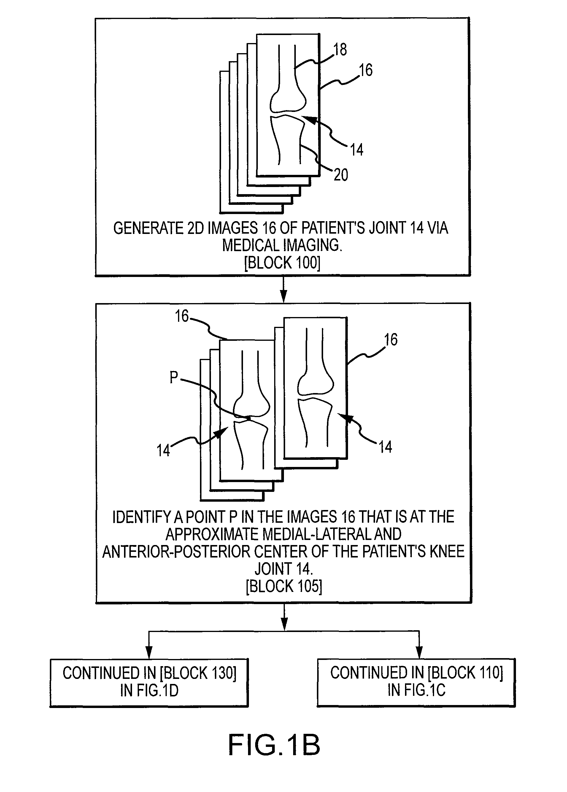 Generation of a computerized bone model representative of a pre-degenerated state and useable in the design and manufacture of arthroplasty devices