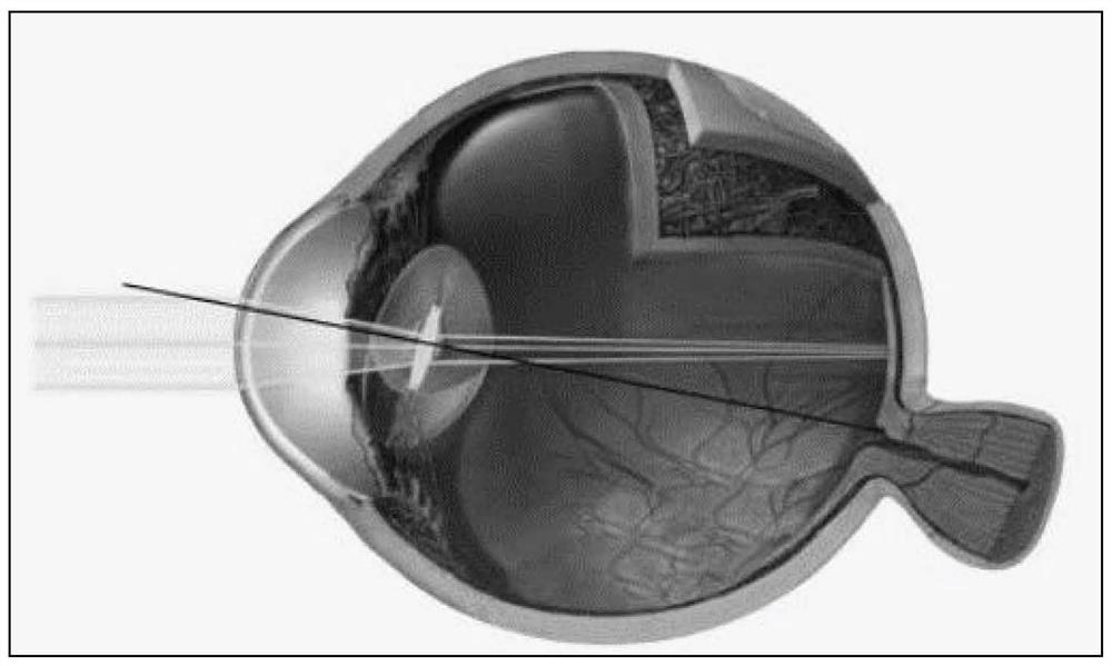Intraocular lens resistant to eccentricity and inclination clinically