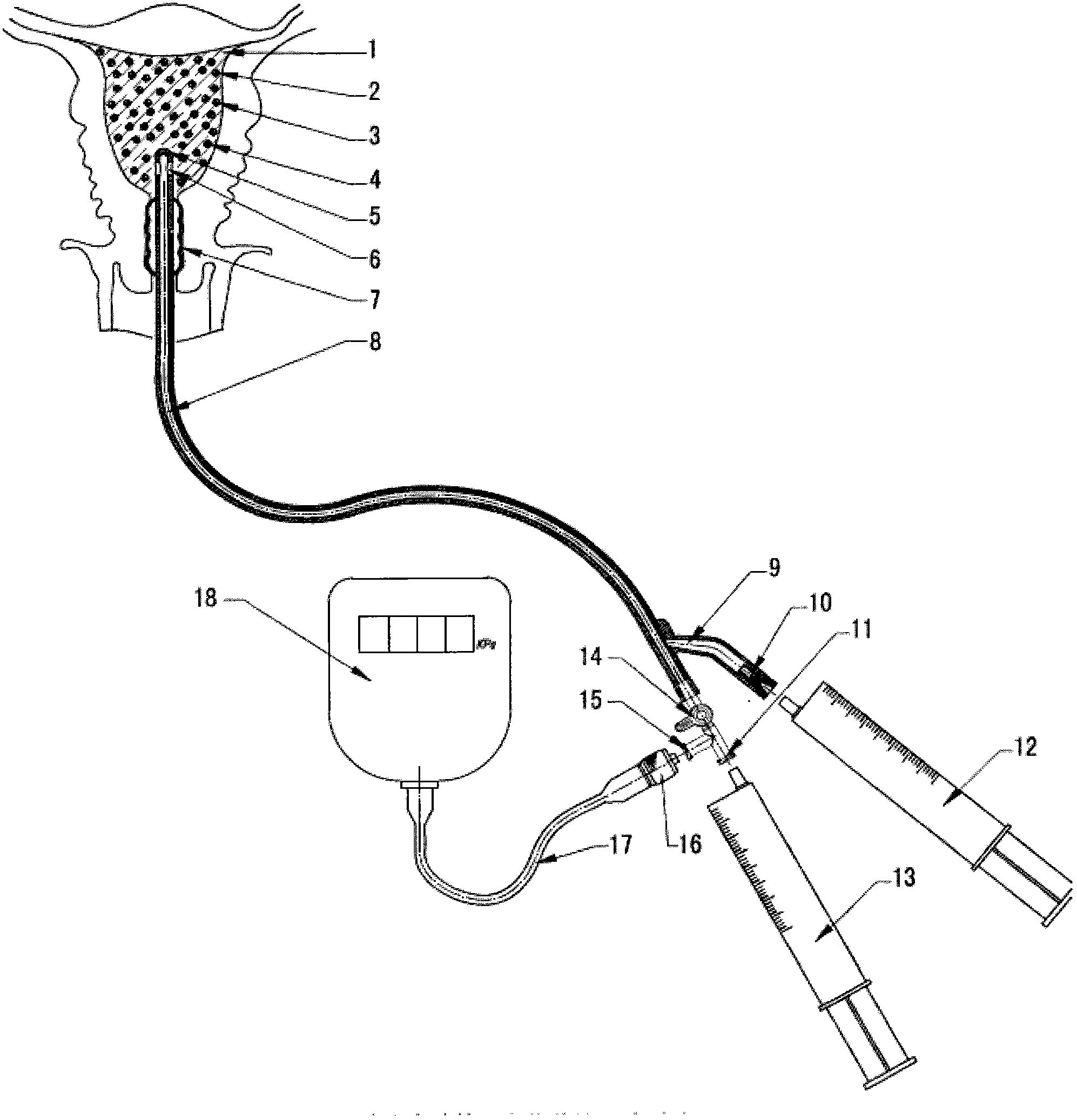 Carrier barrier system applied to prevention and treatment of metrosynizesis
