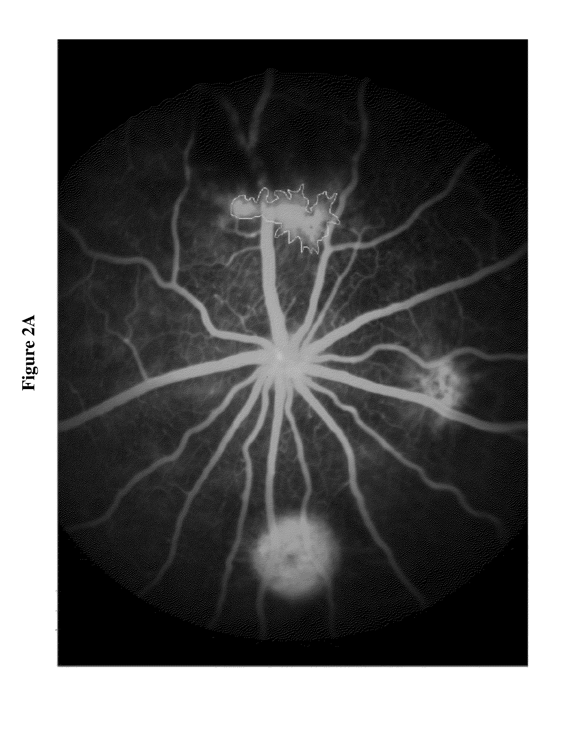 Compositions and methods for treatment of diabetic macular edema
