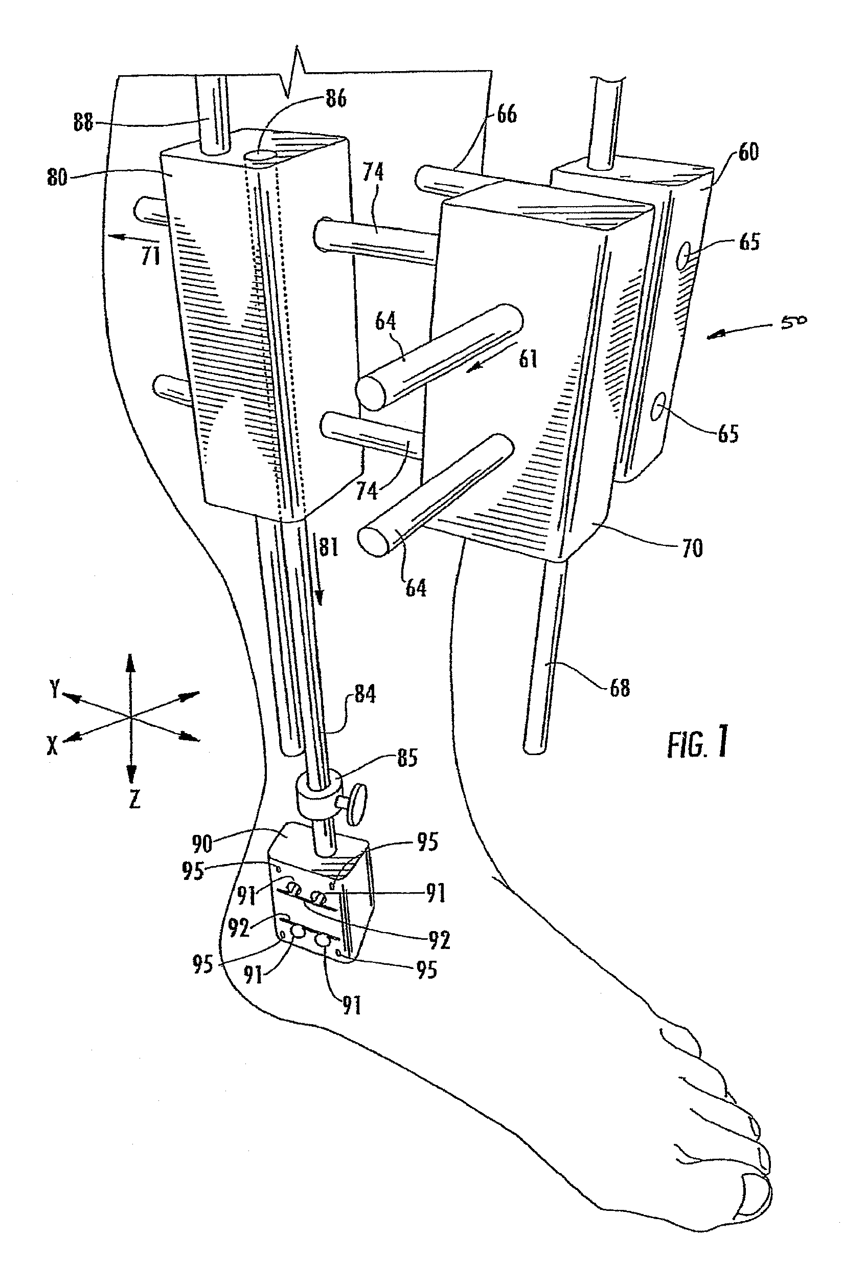 Method of preparing an ankle joint for replacement, joint prosthesis, and cutting alignment apparatus for use in performing an arthroplasty procedure