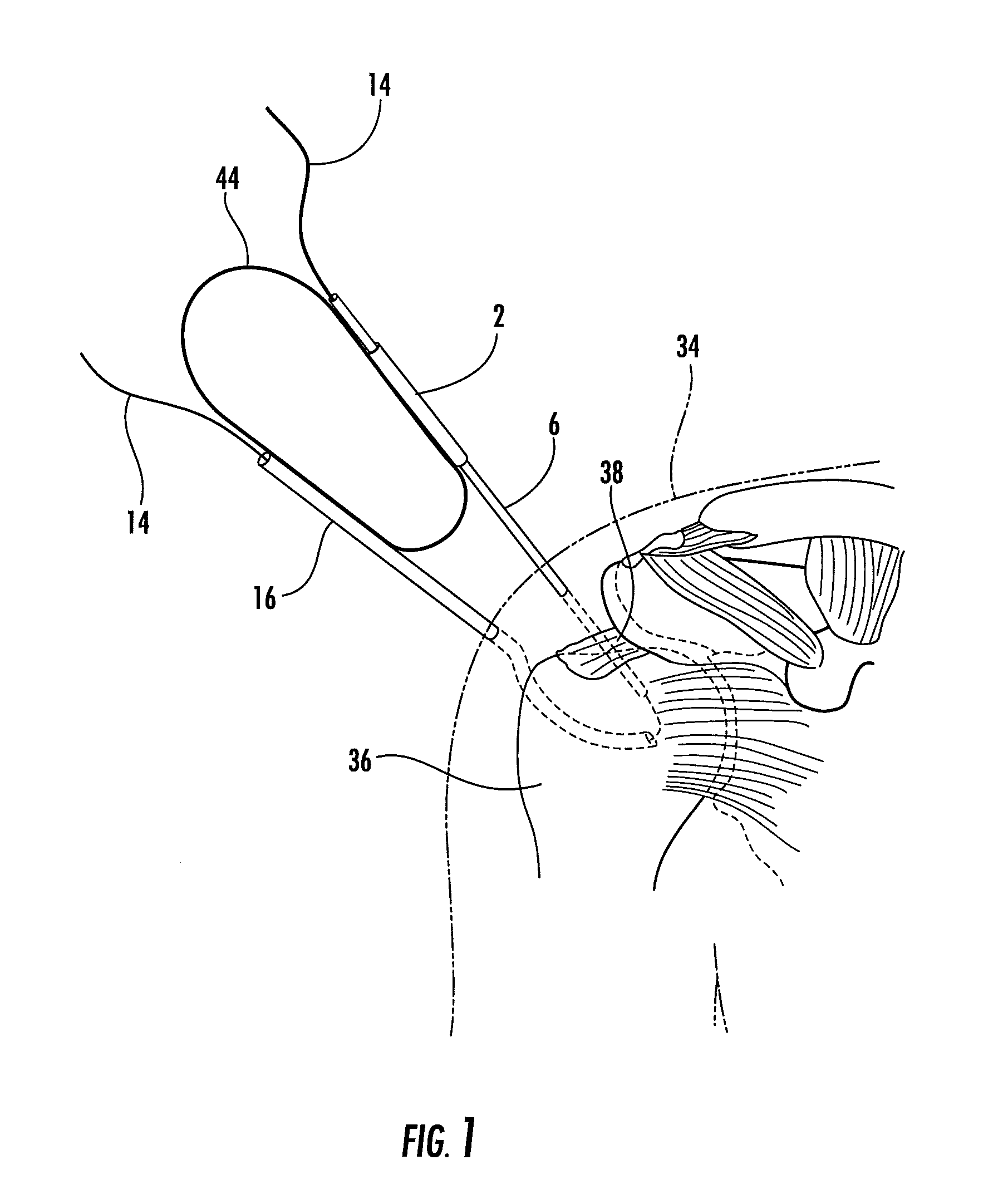 Suture Passer and Subcortical Knot Placement