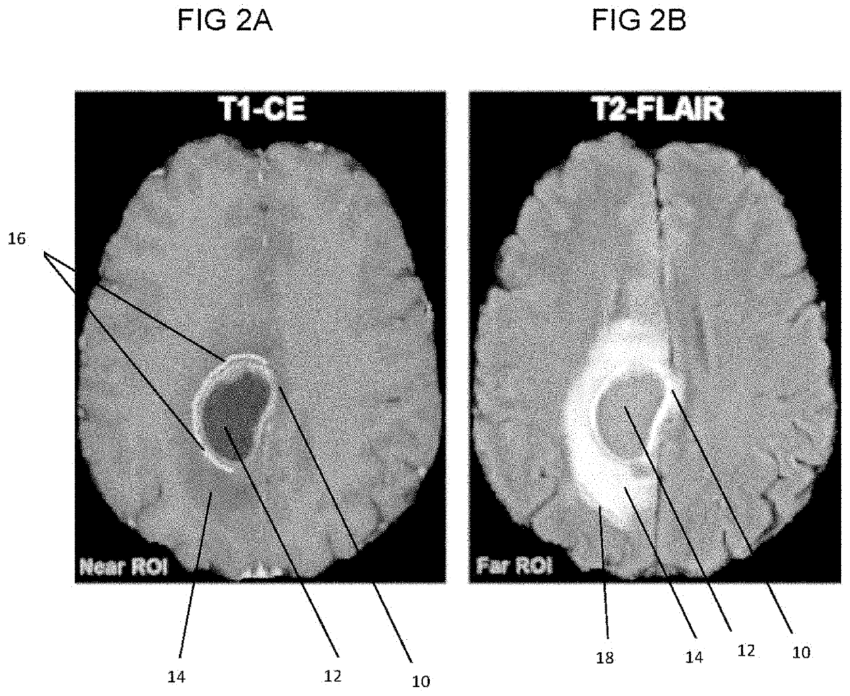 In vivo detection of EGFR mutation in glioblastoma via MRI signature consistent with deep peritumoral infiltration