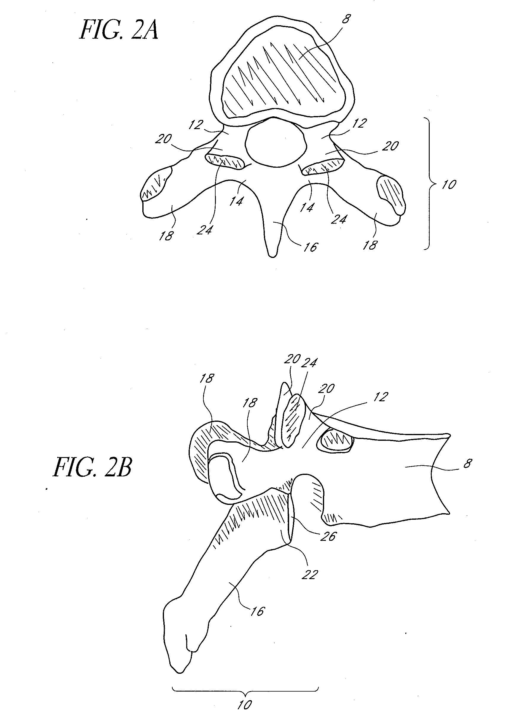 Vertebral facet joint prosthesis and method of fixation