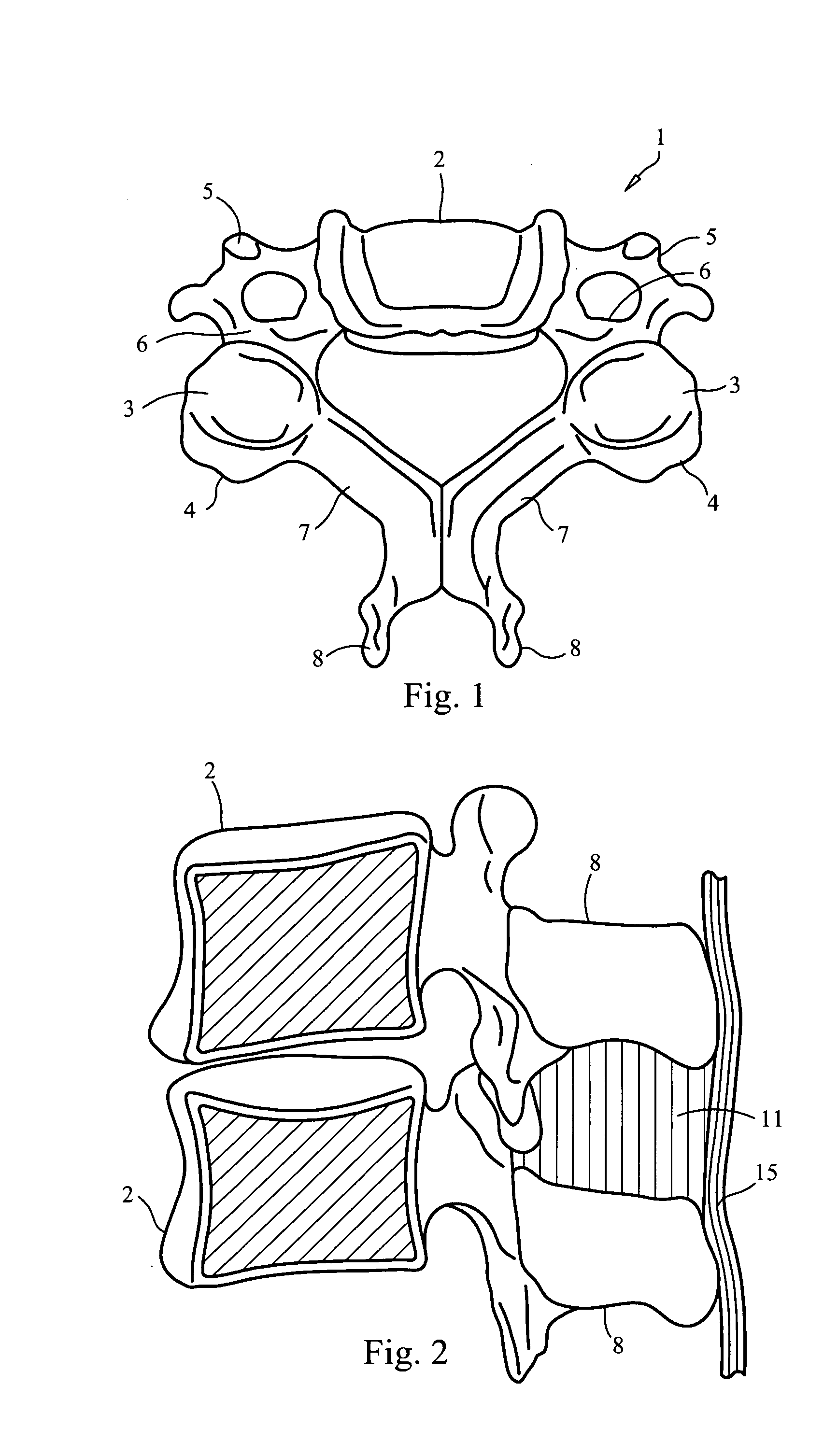 Interspinous implant, tools and methods of implanting