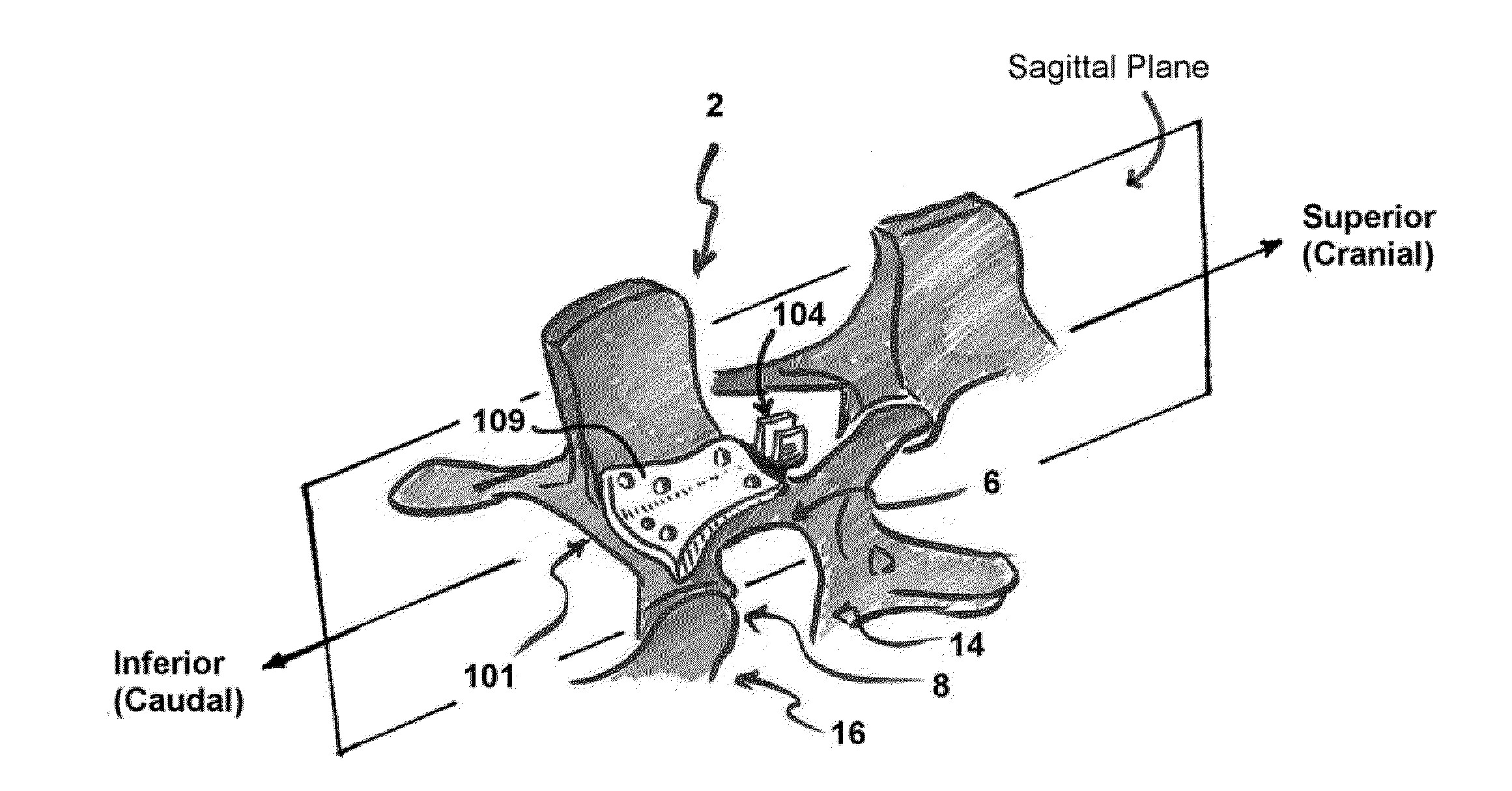 System and method to stablize a spinal column including a spinolaminar locking plate