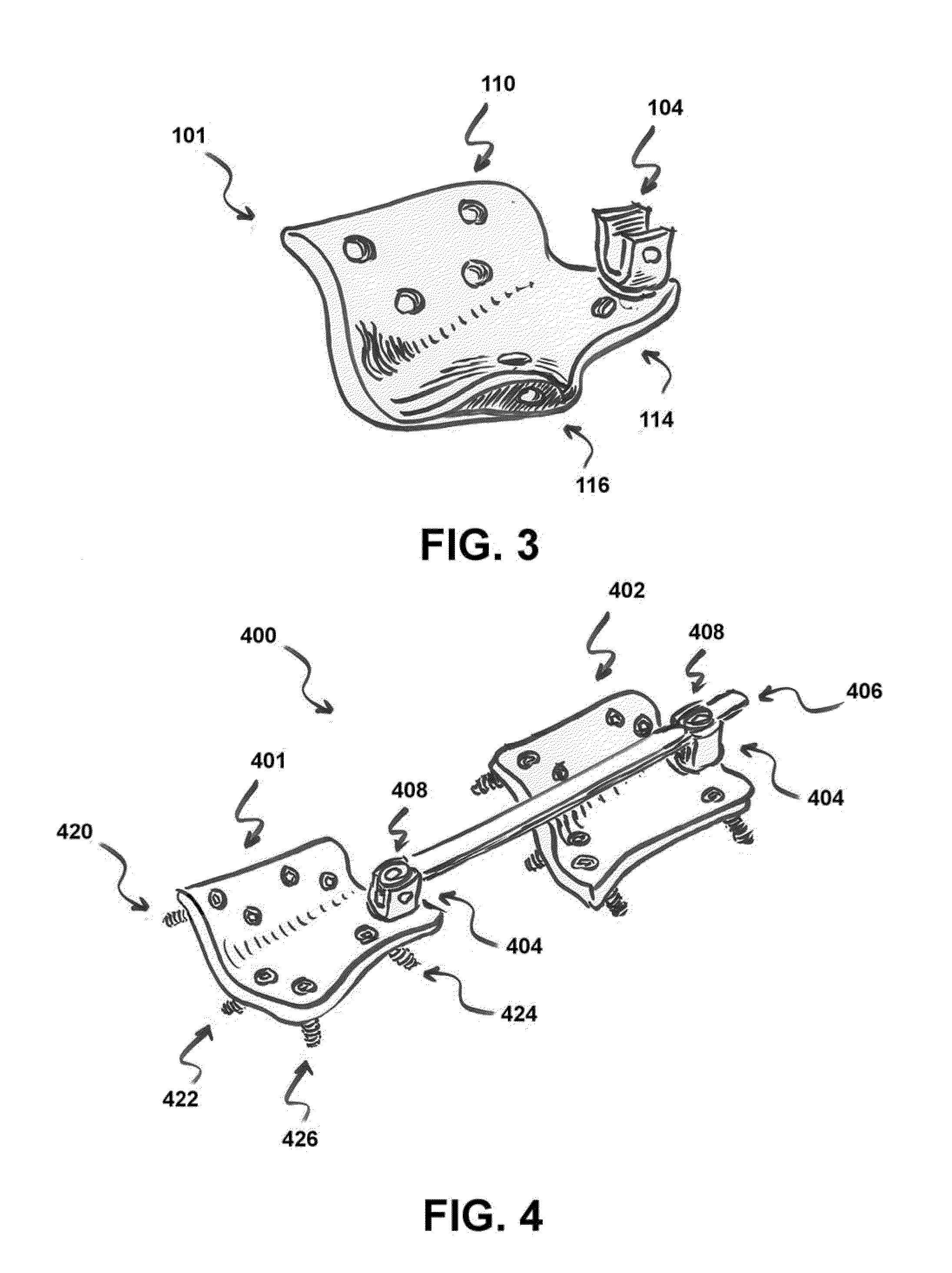 System and method to stablize a spinal column including a spinolaminar locking plate