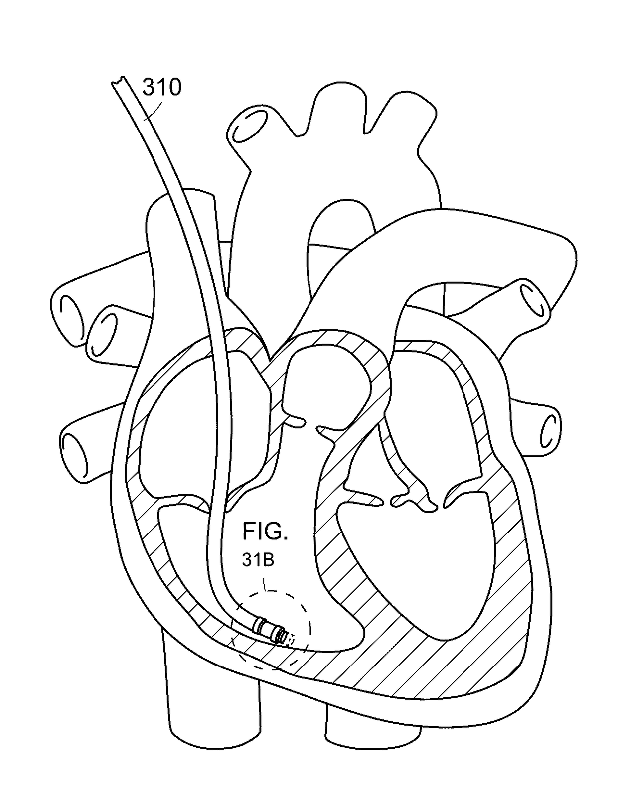Catheters, systems, and related methods for mapping, minimizing, and treating cardiac fibrillation
