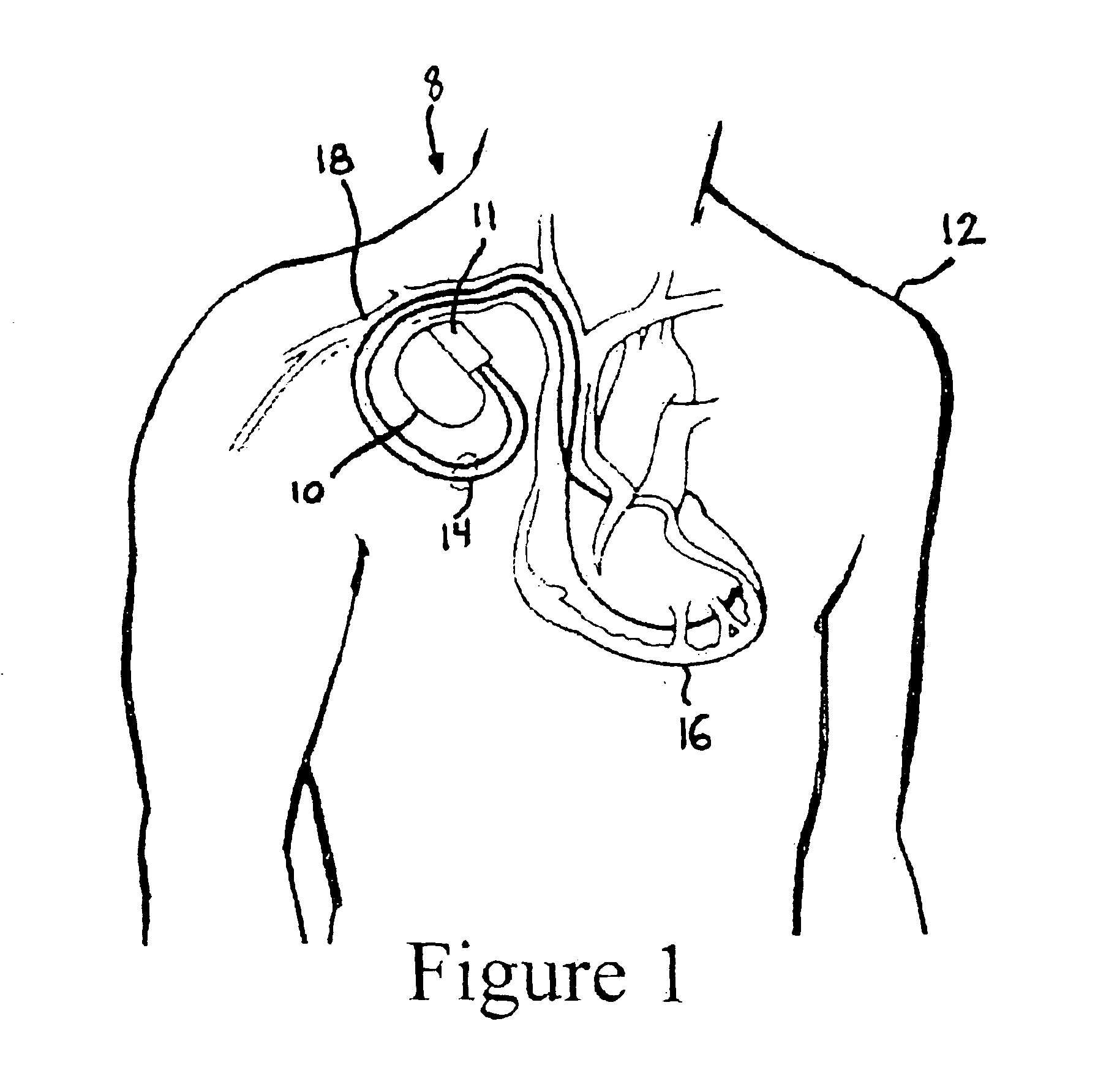 Method and apparatus for placing a coronary sinus/cardiac vein pacing lead using a multi-purpose side lumen