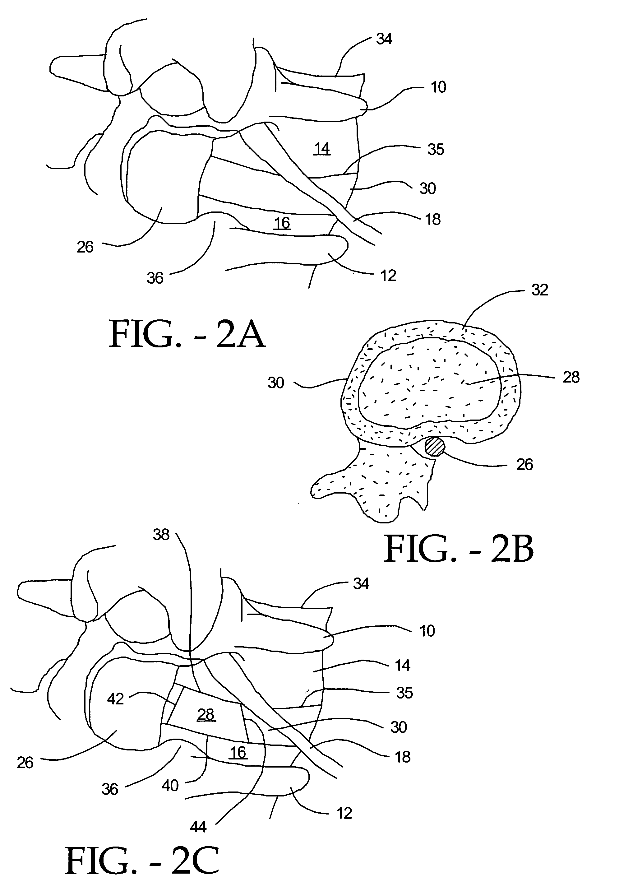 Multi-piece artificial spinal disk replacement device with multi-segmented support plates