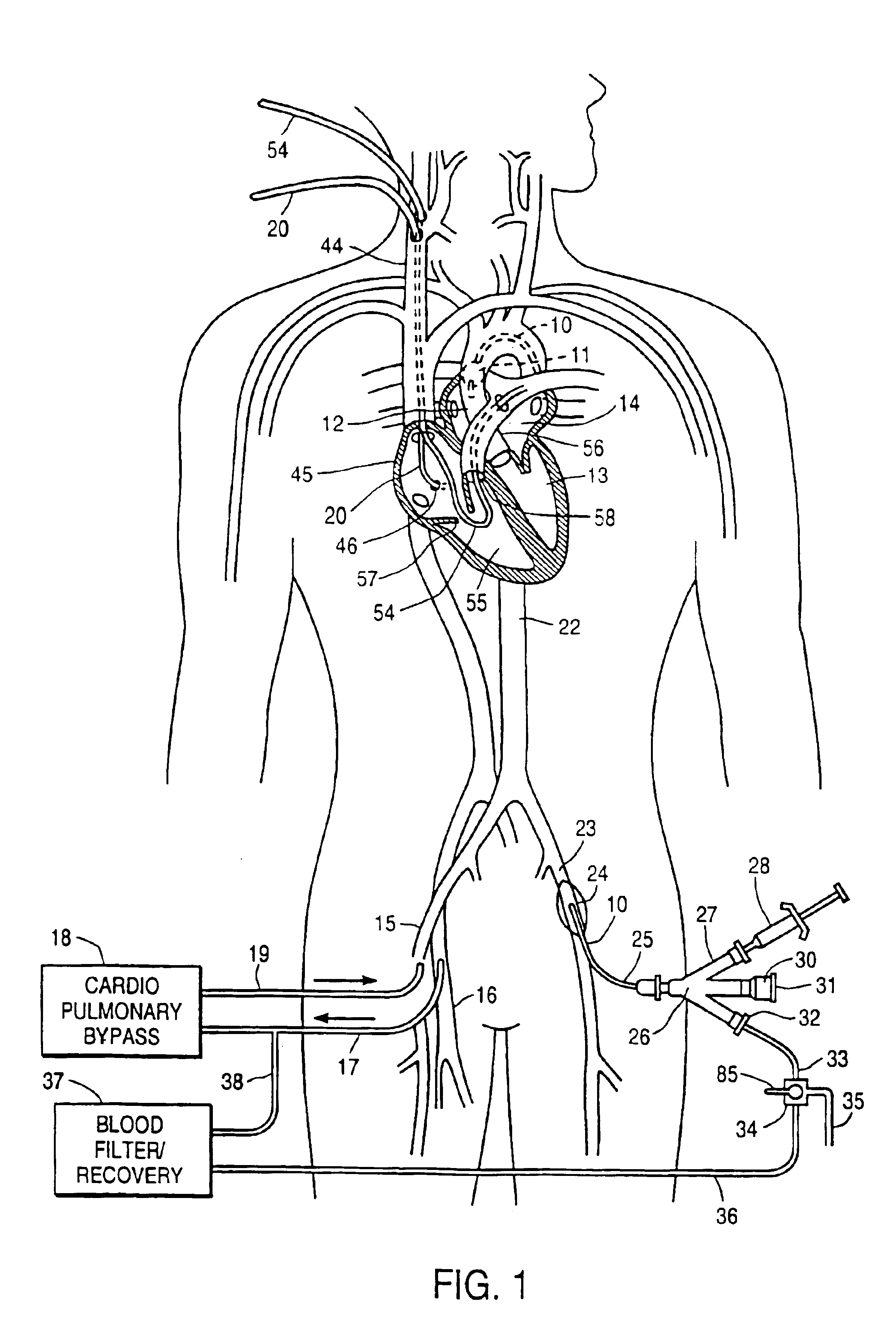 Endovascular system for arresting the heart