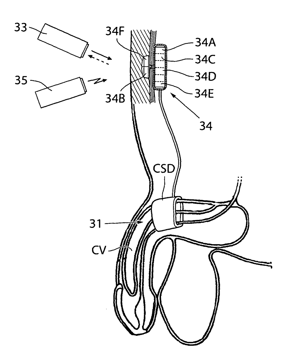 Method for controlling flow in a bodily organ