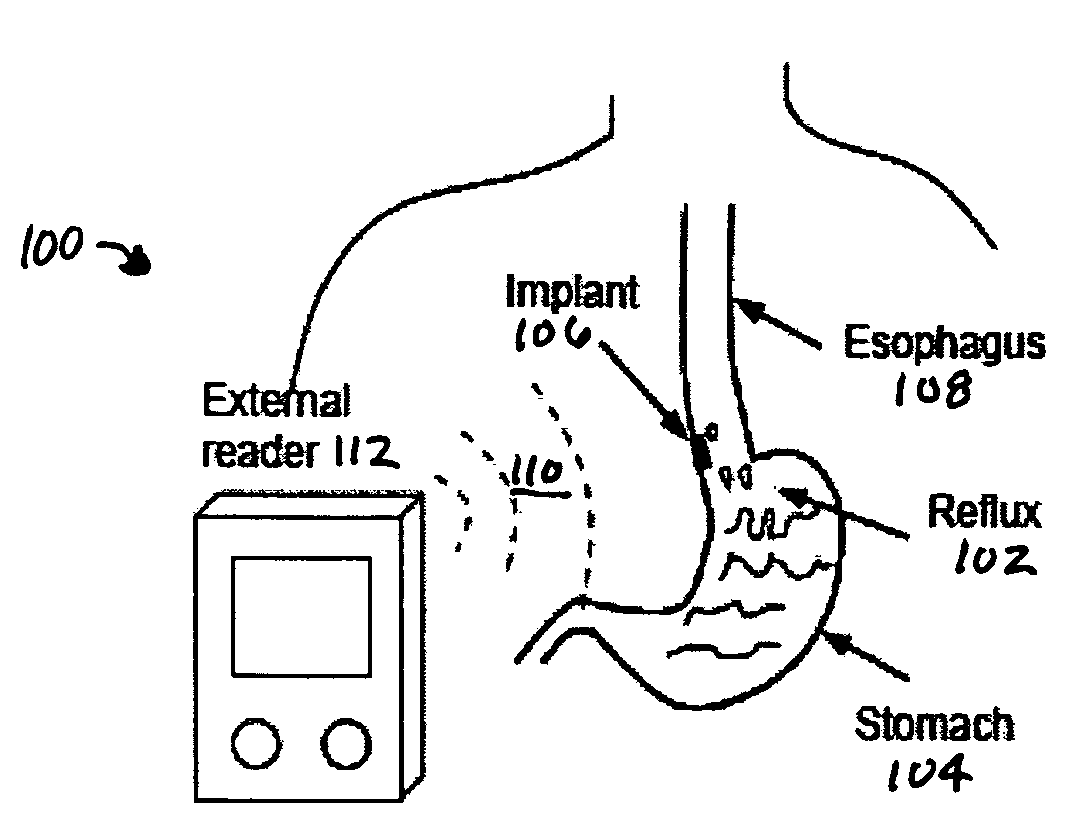 Passive Wireless Gastroesophageal Sensor