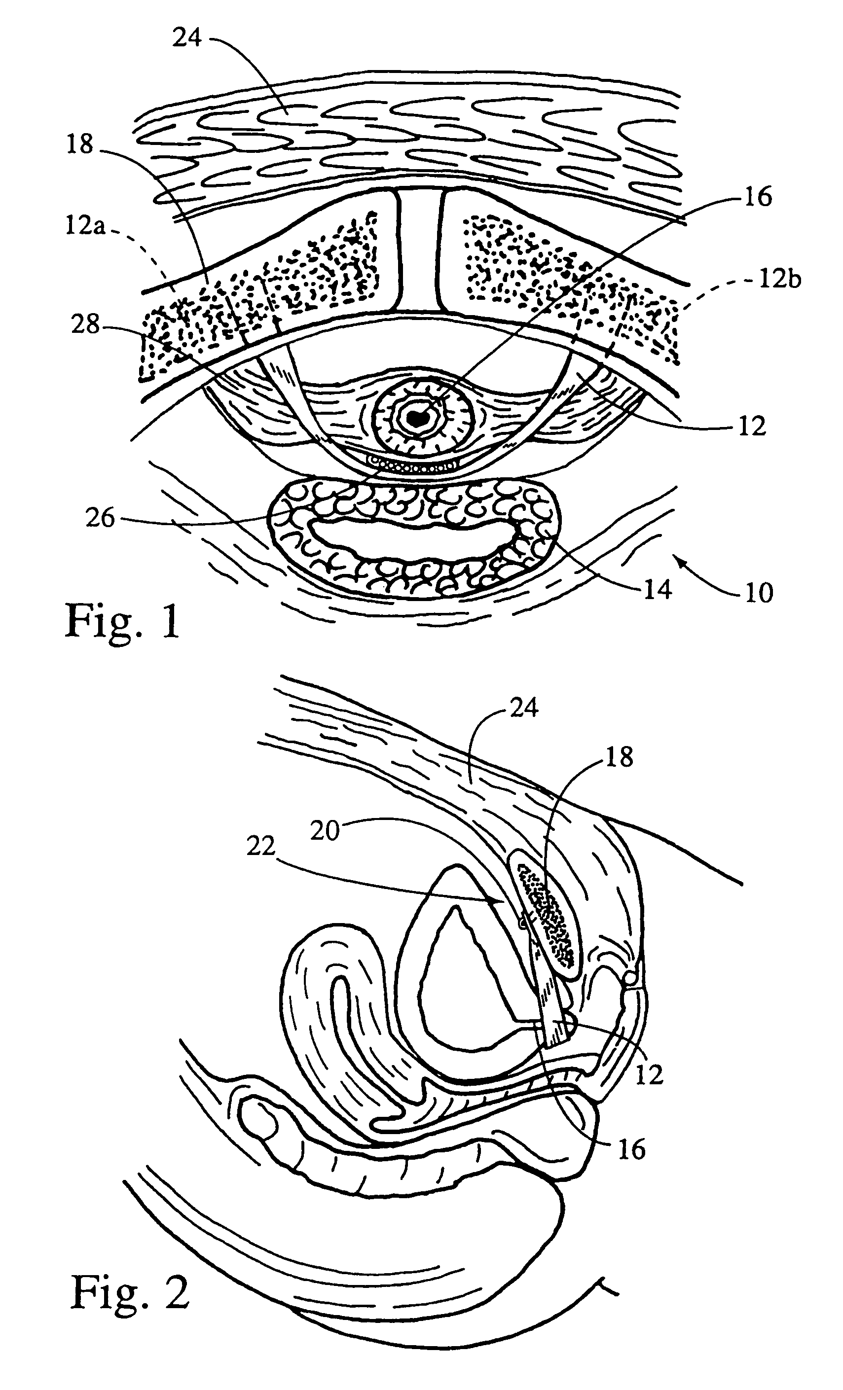 System and method for securing implants to soft tissue