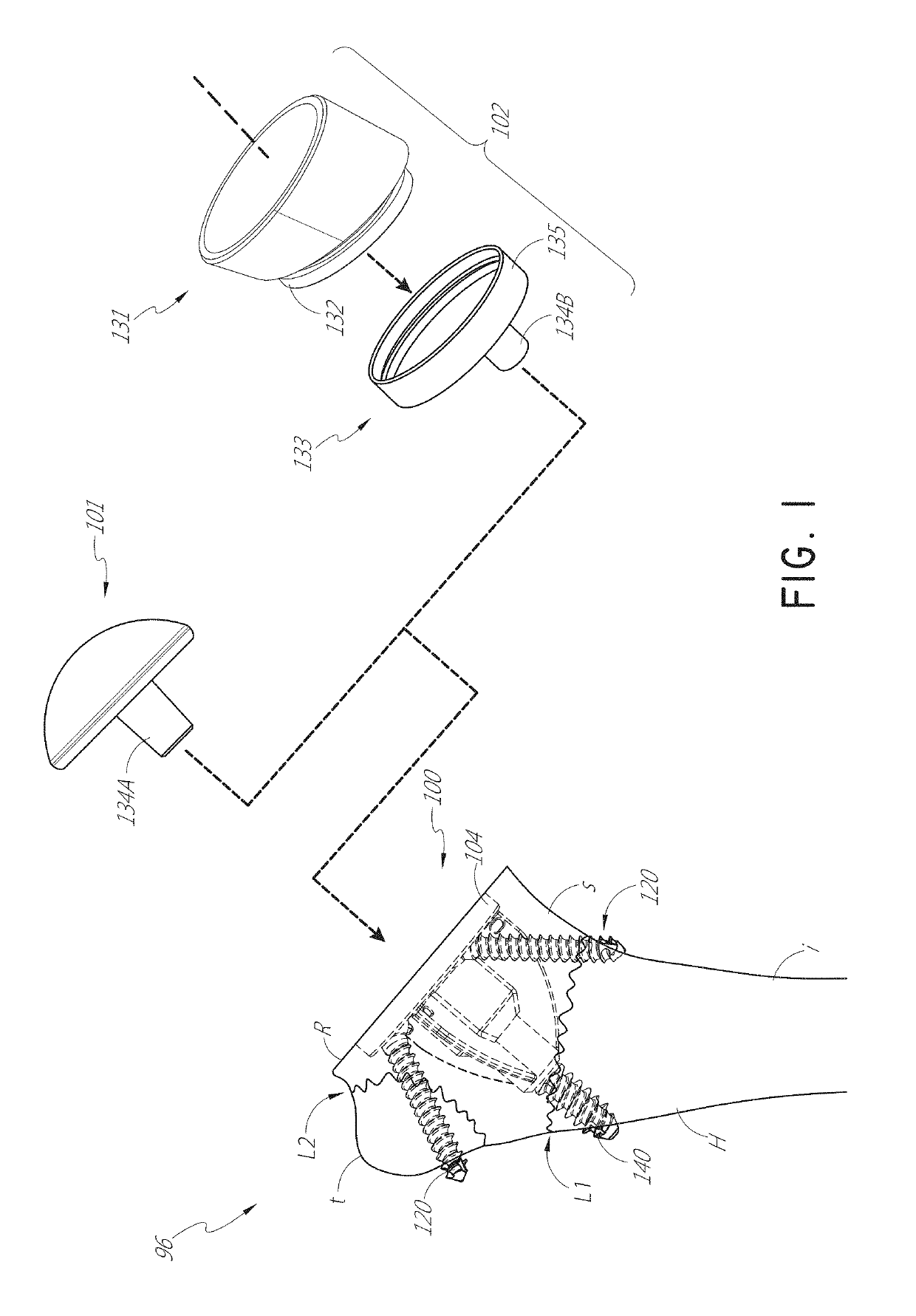 Stemless shoulder implant with fixation components