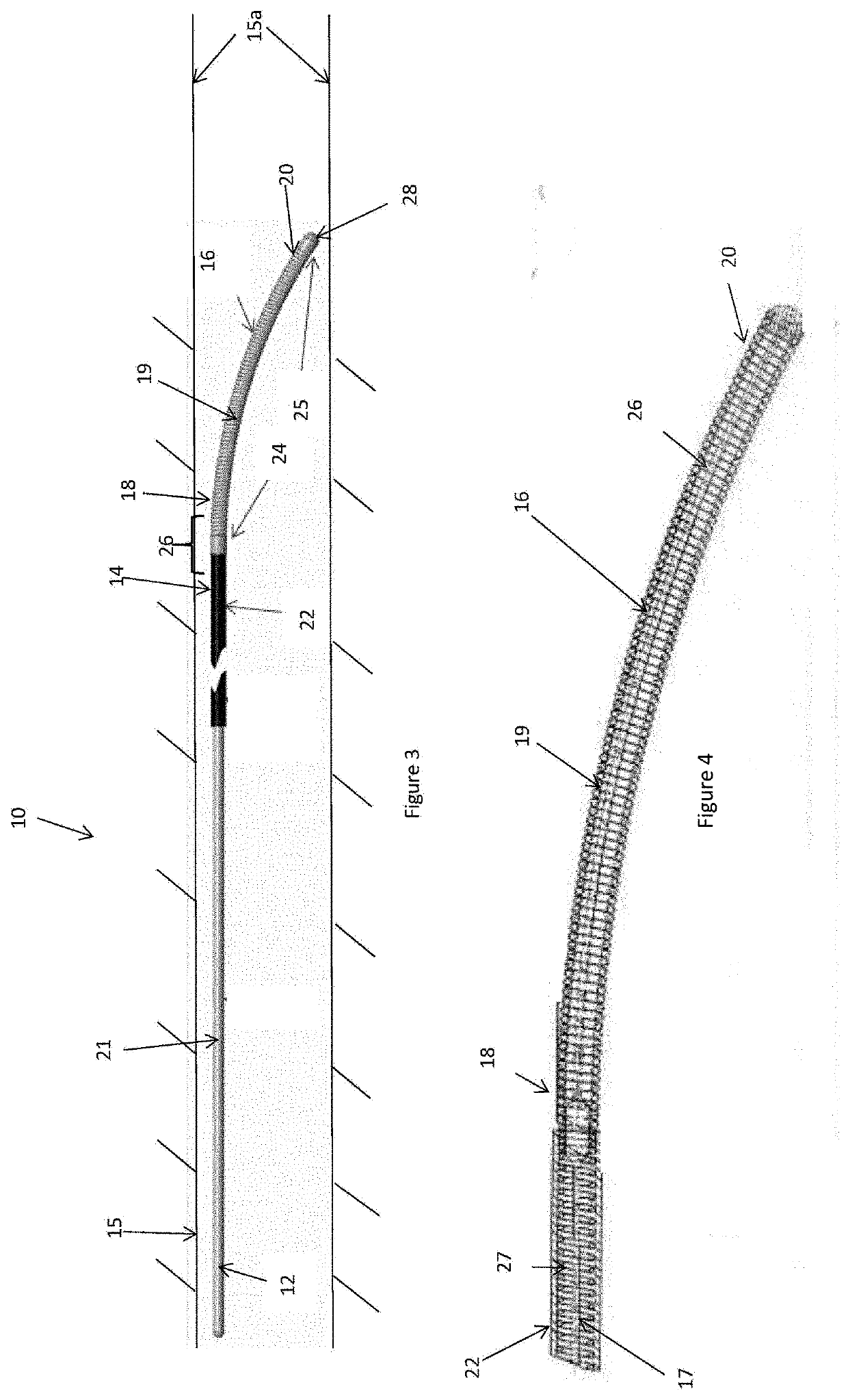 Energy delivery device for endovascular occlusion