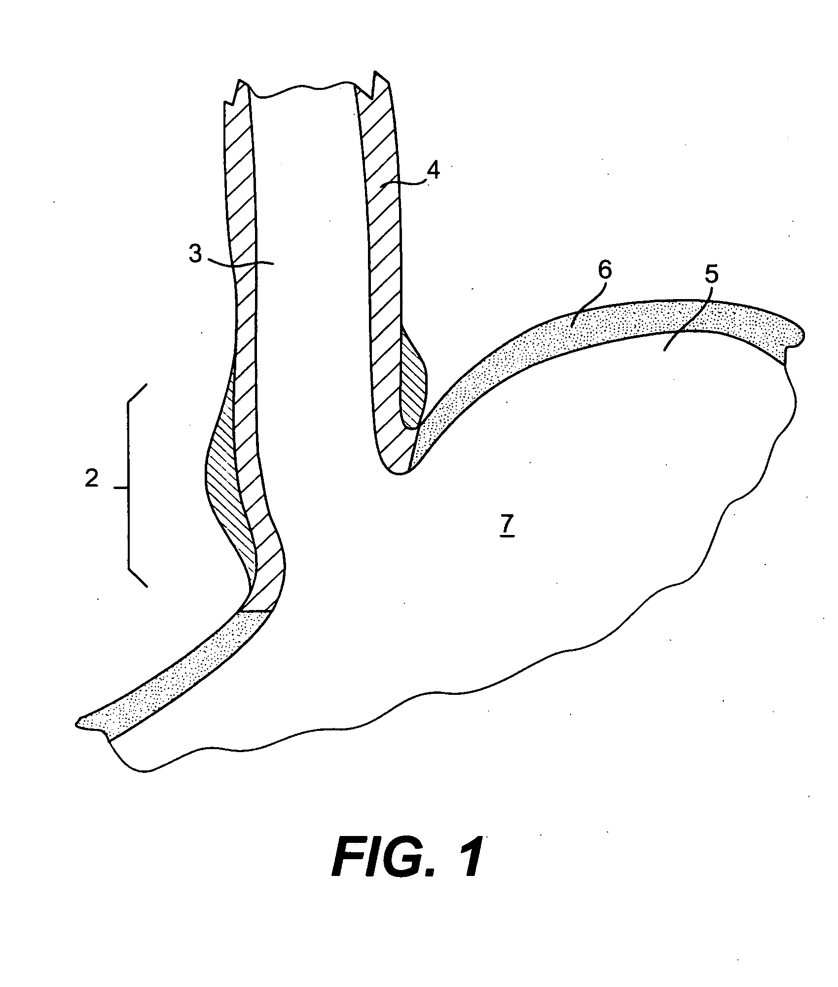 Tissue fasteners and related deployment systems and methods