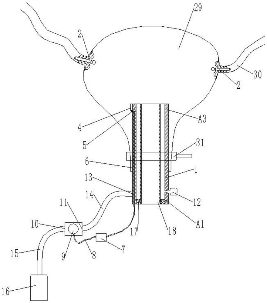 Waterproof poisoning auxiliary device for hysteroscopic surgery controlled by airtight constant pressure