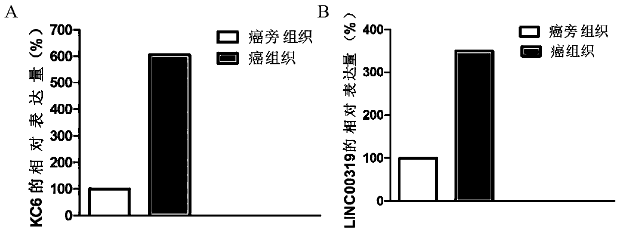 Application of miR-1207 and target gene of miR-1207 in detecting laryngeal squamous cell carcinoma