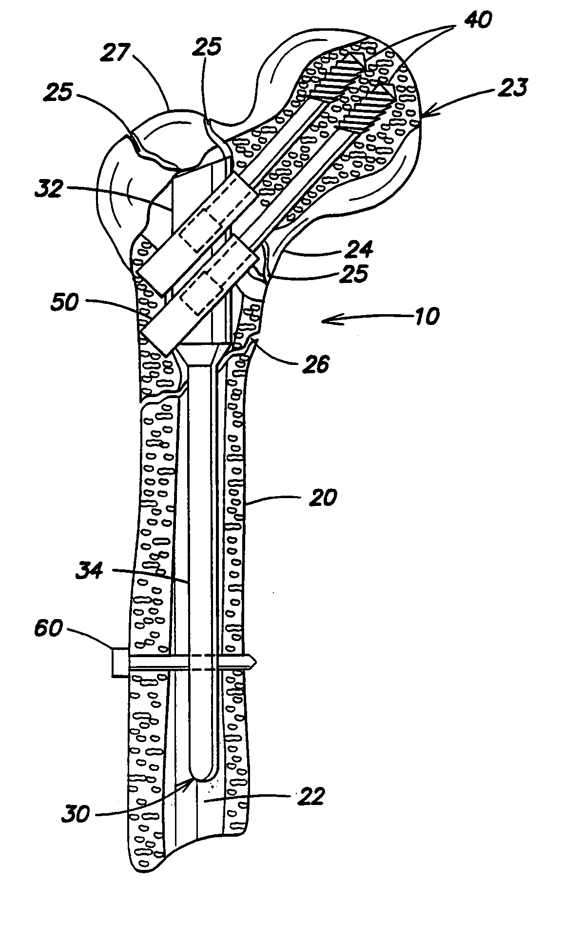 Intramedullary nail system and method for fixation of a fractured bone