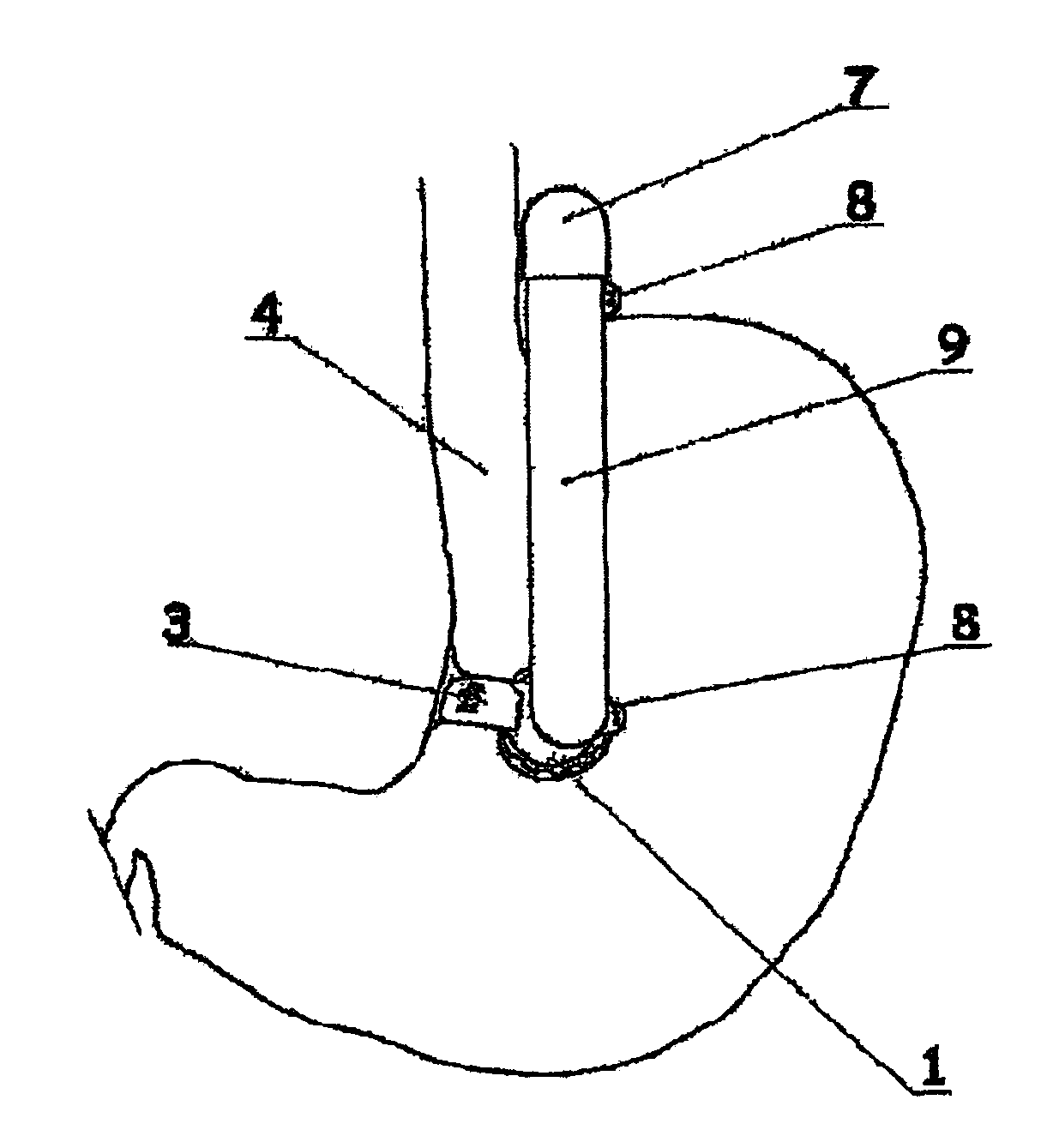 Gastric clamp for performing vertical band gastroplasty and a gastric bypass with lesser curvature