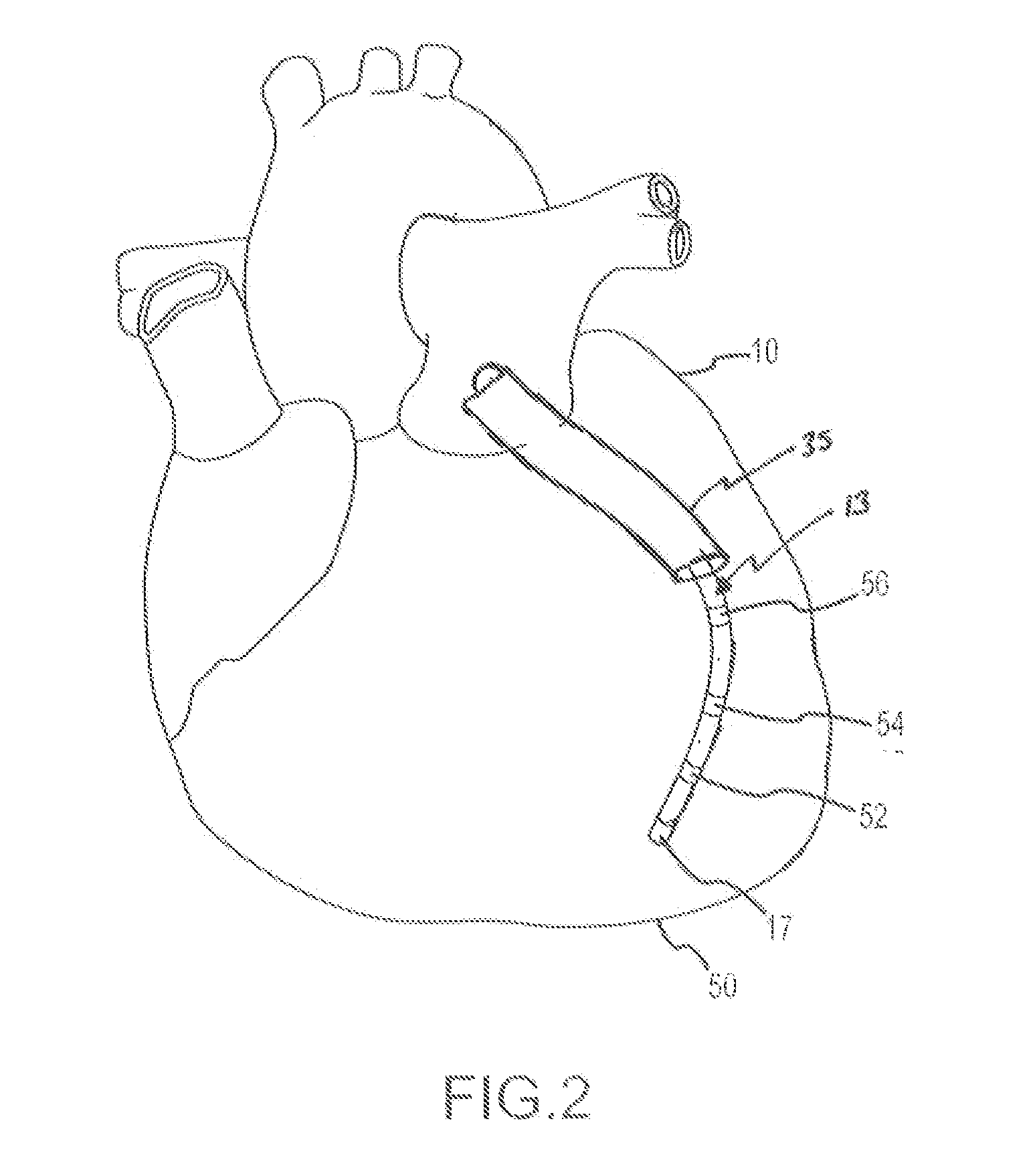 System and Method for Detecting Sheathing and Unsheathing of Localization Elements
