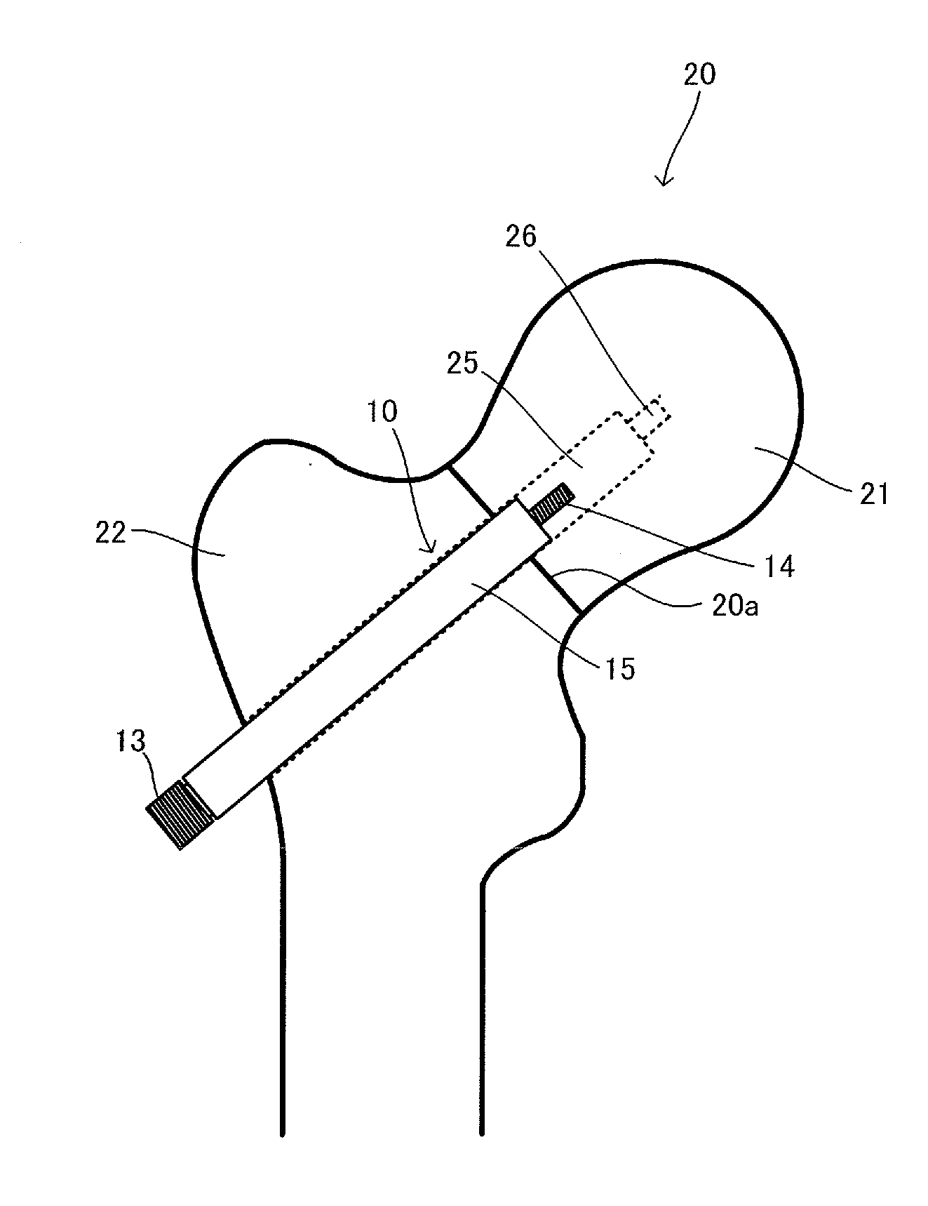 Fracture treatment device