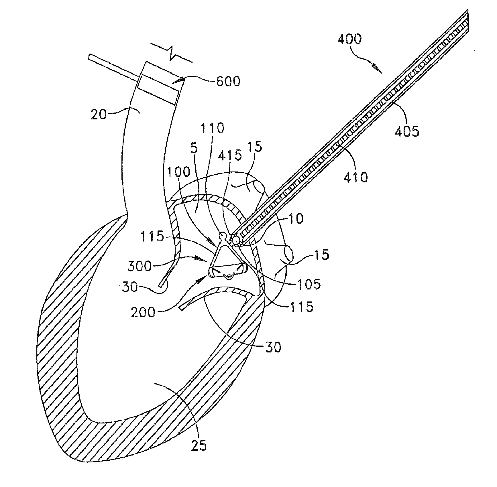 Method For Replacing Native Valve Function Of A Diseased Aortic Valve