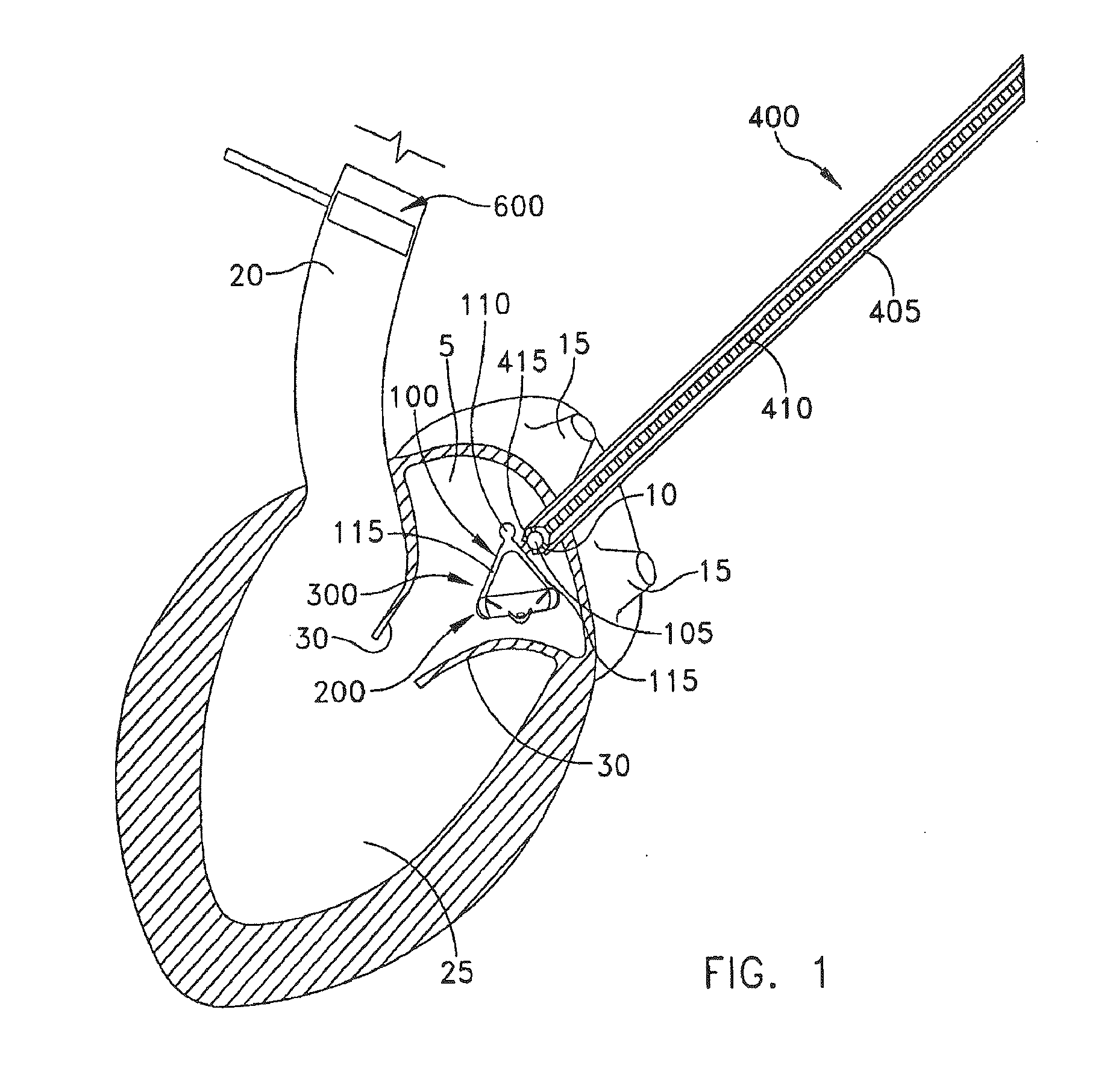 Method For Replacing Native Valve Function Of A Diseased Aortic Valve