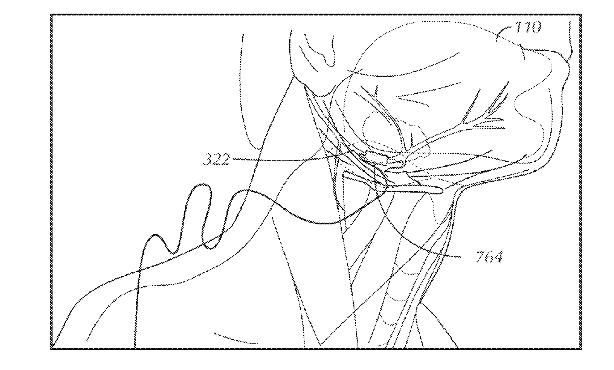 Stimulation of a Hypoglossal Nerve for Controlling the Position of a Patient's Tongue