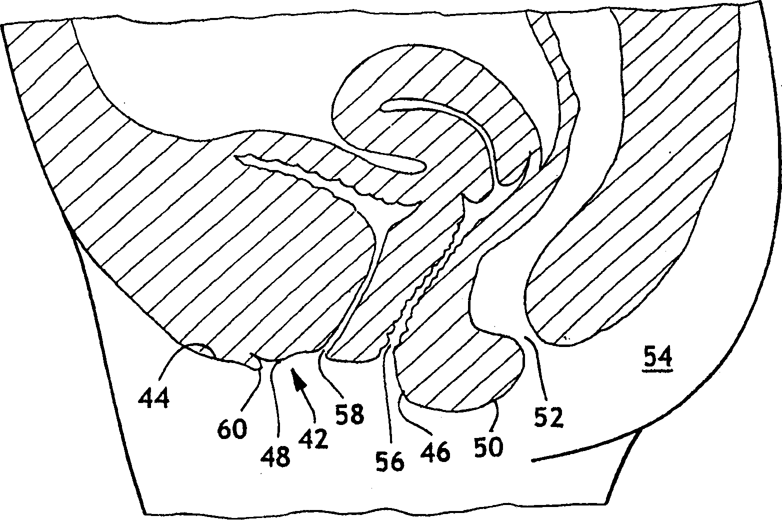 Labial pad having a notch