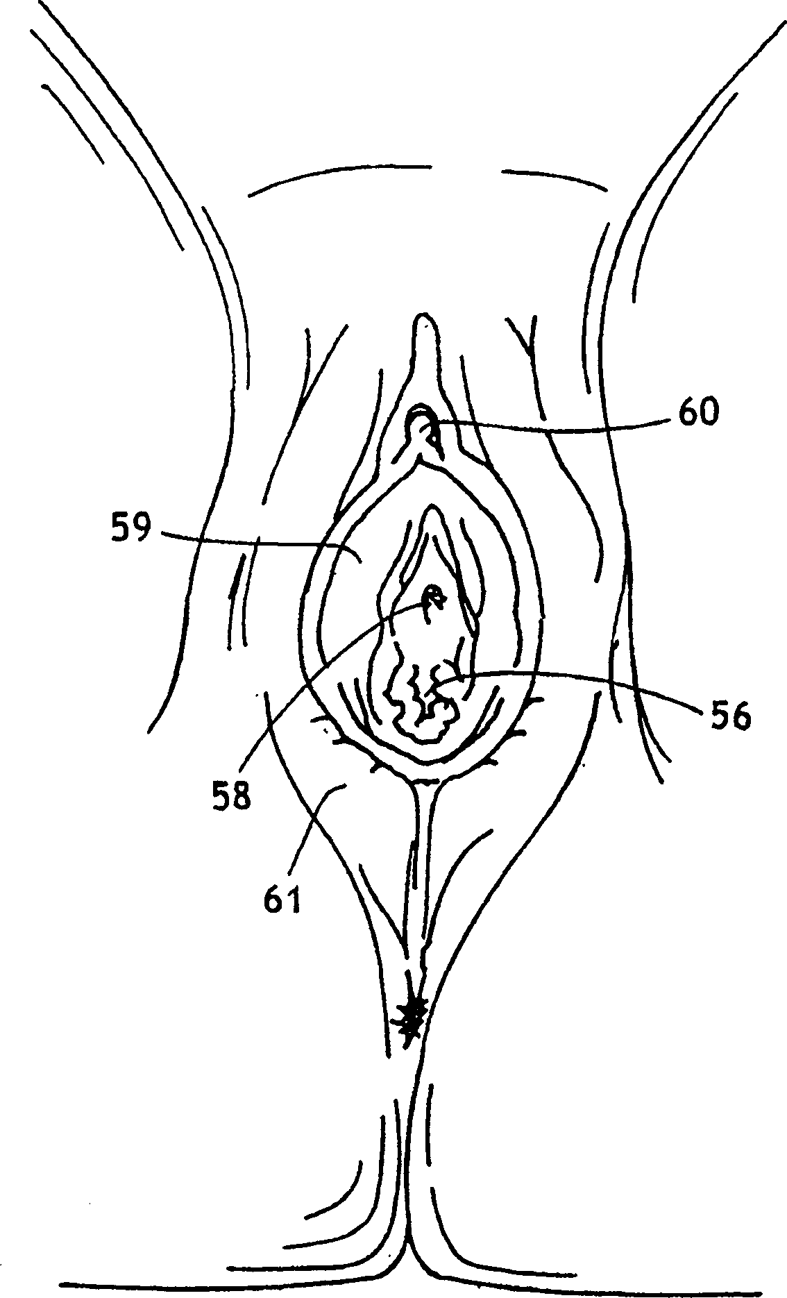 Labial pad having a notch