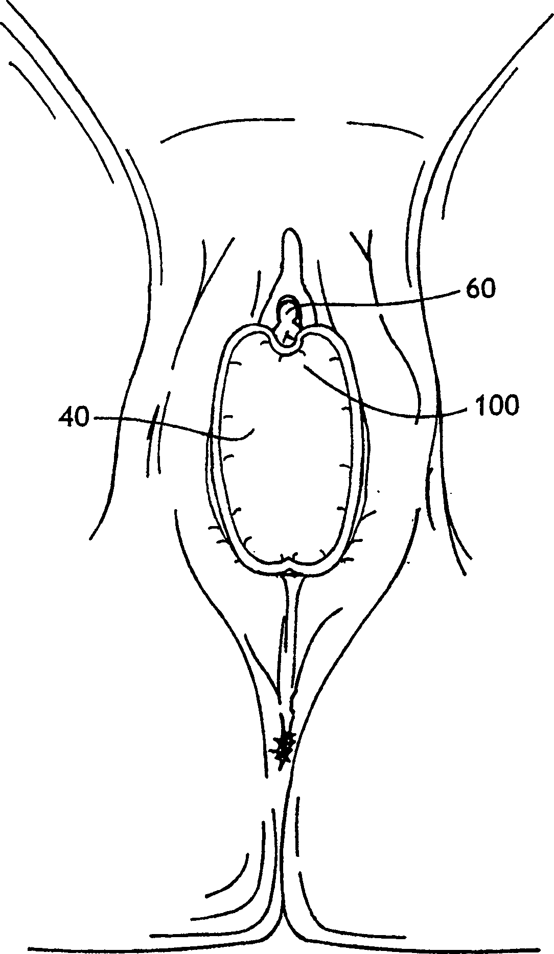 Labial pad having a notch